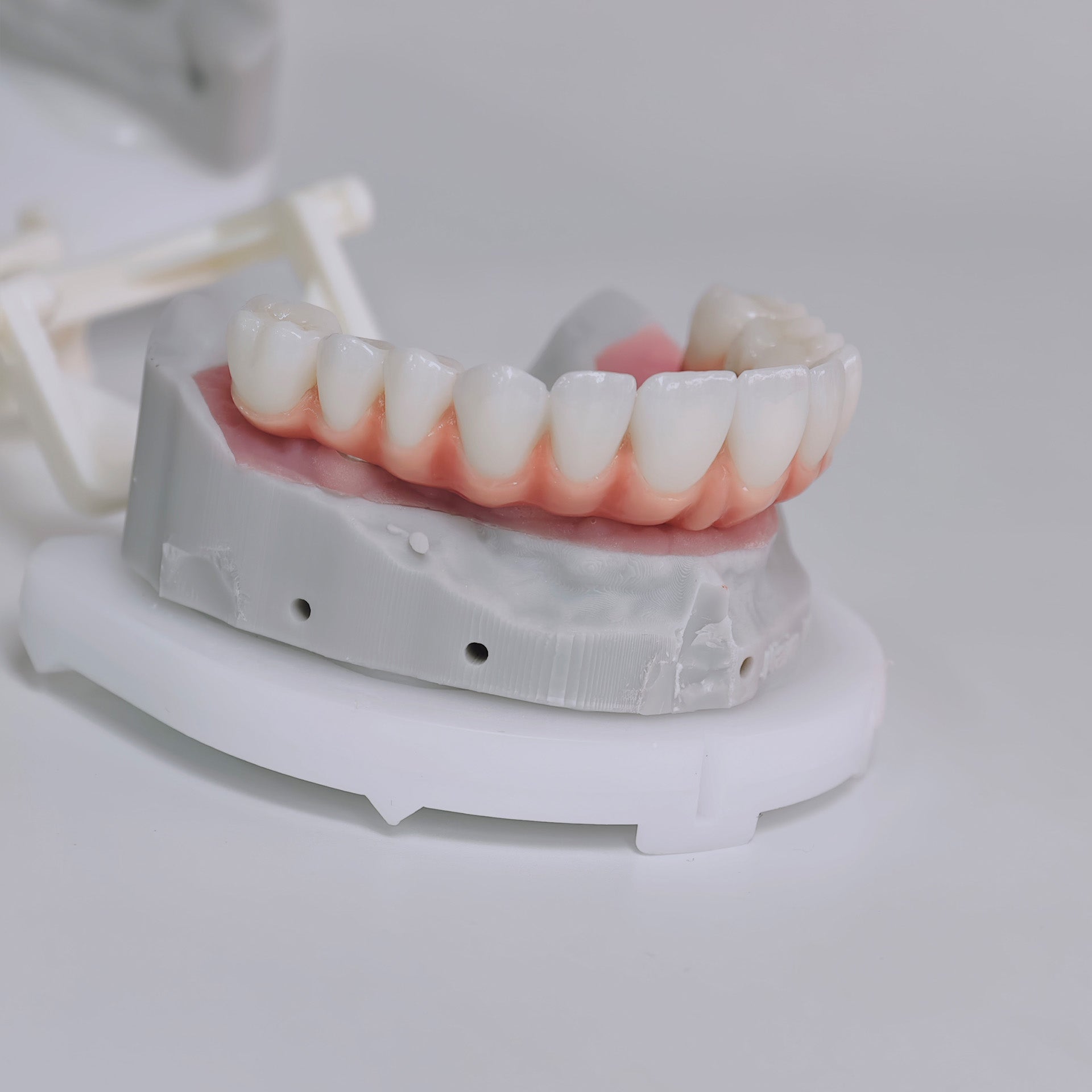 Zirconia-Enamel Hybrid Malo Bridge Aesthetic