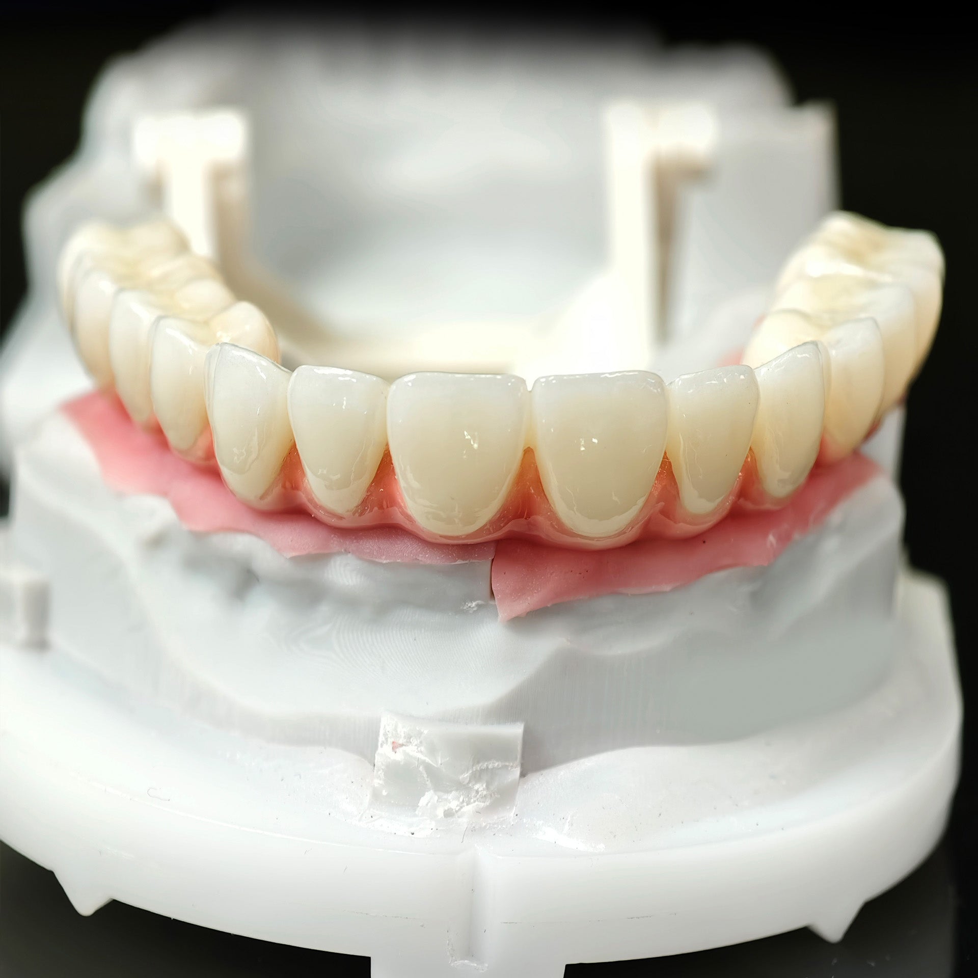 Zirconia-Enamel Hybrid Malo Bridge