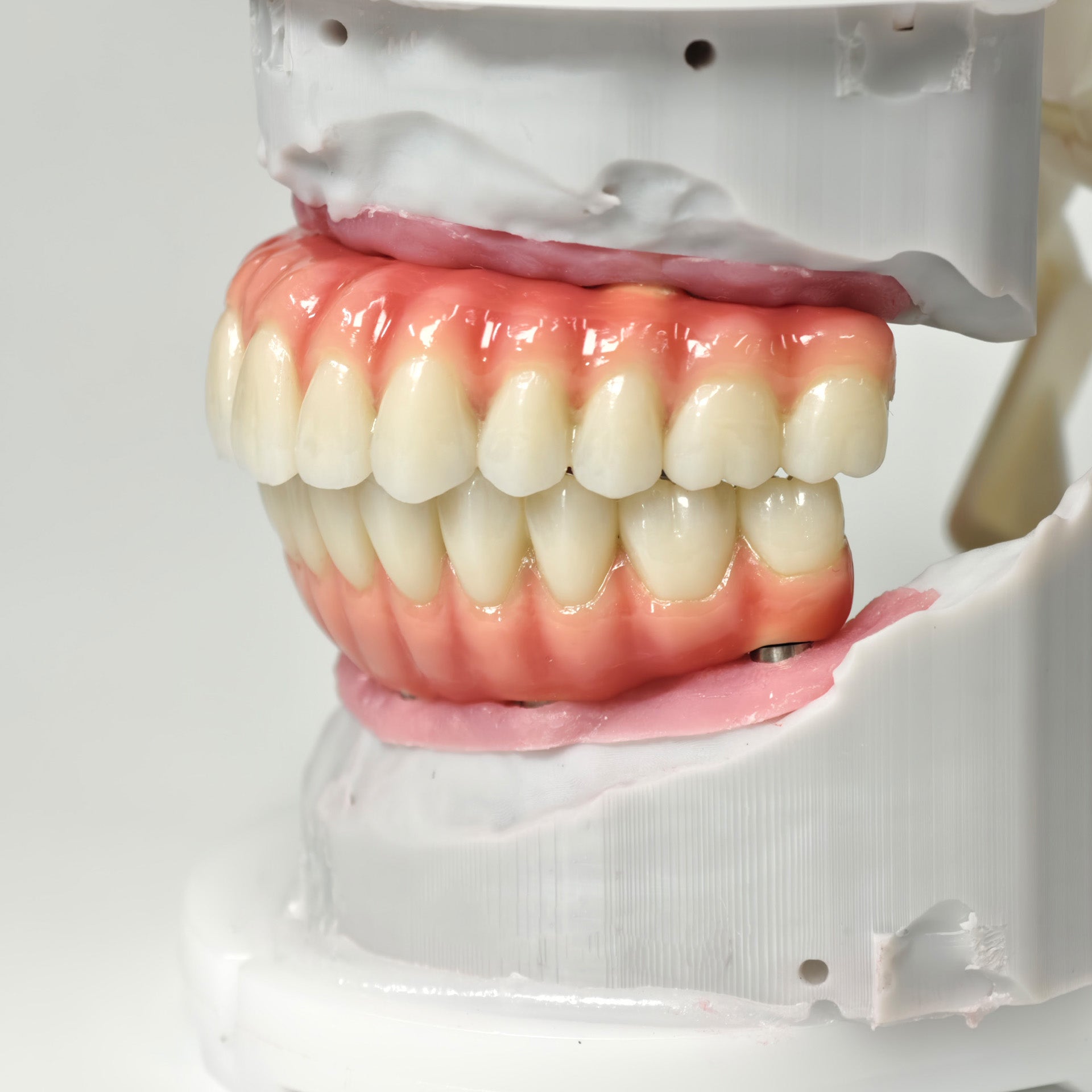 Zirconia-Enamel Hybrid Malo Bridge
