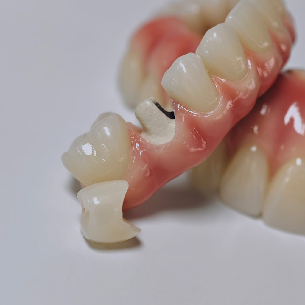Zirconia-Enamel Hybrid Malo Bridge