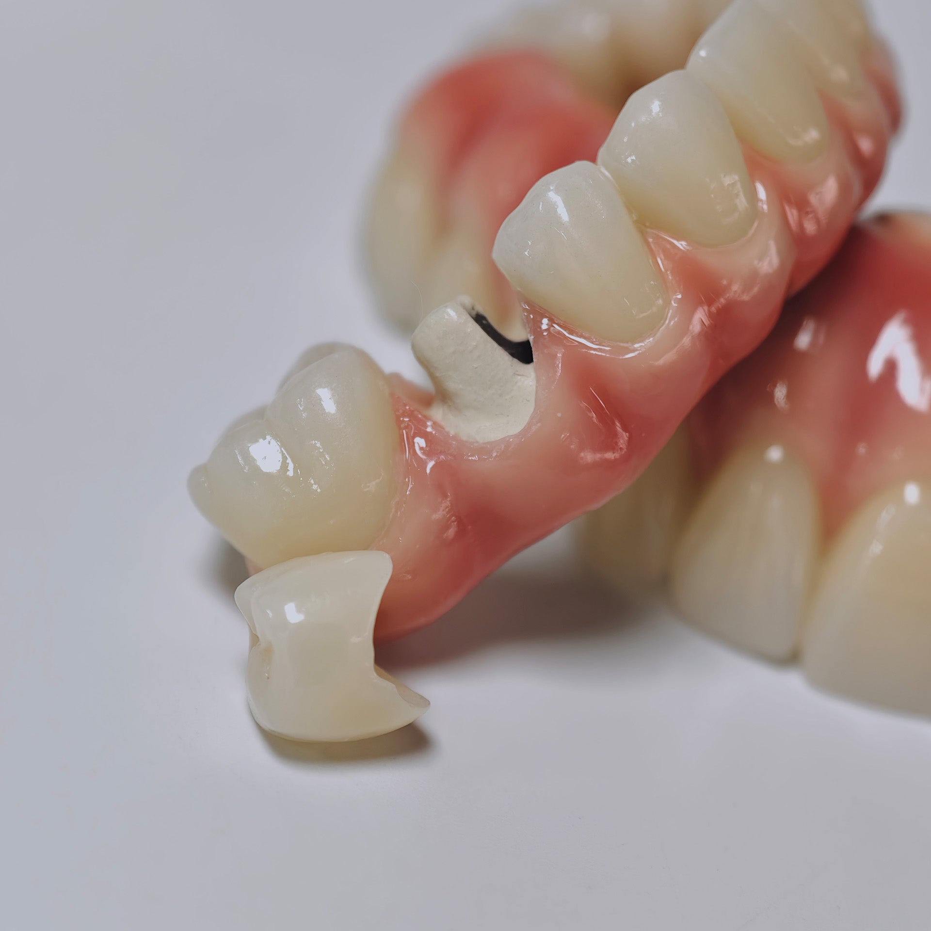 Zirconia-Enamel Hybrid Malo Bridge