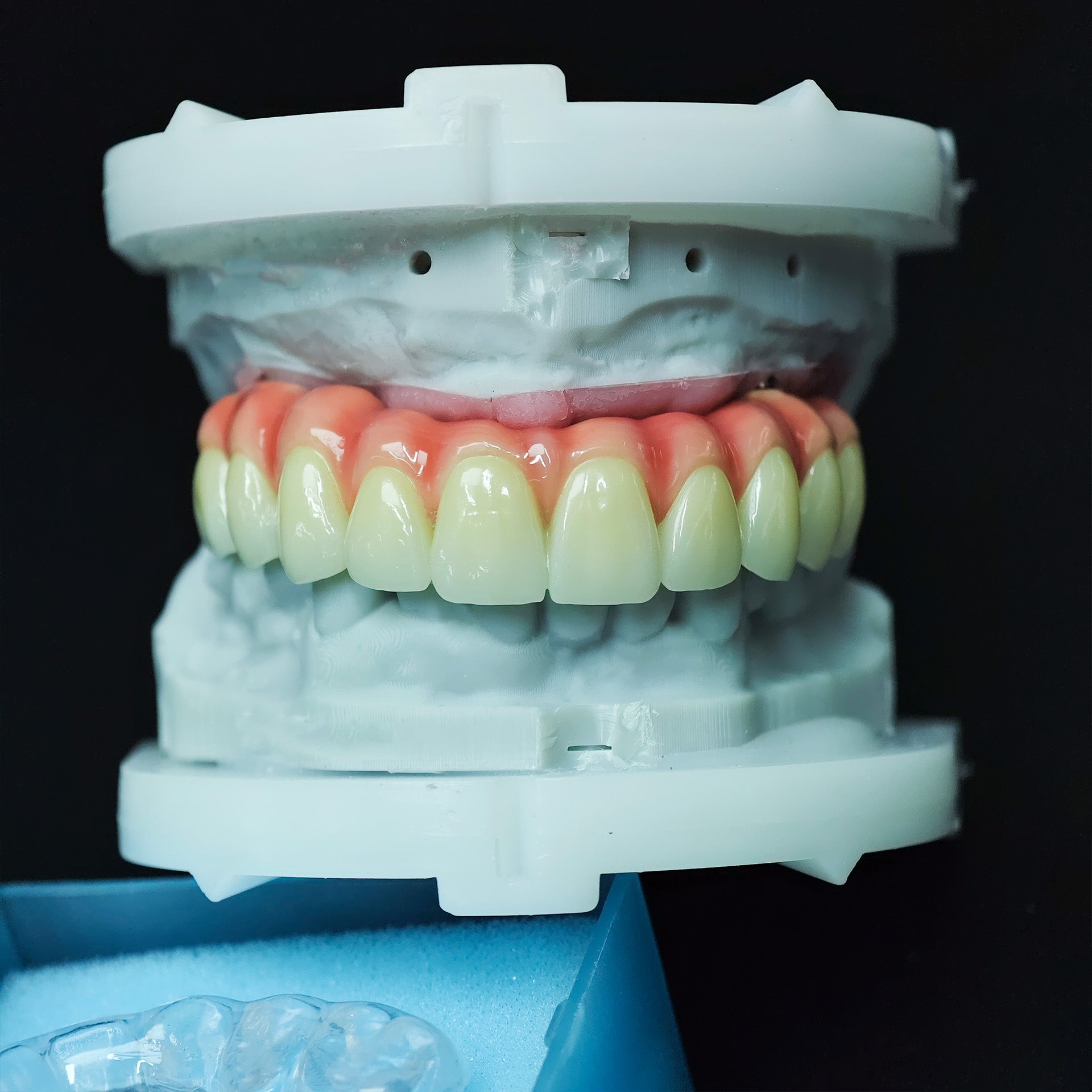 Zirconia-Enamel Hybrid Malo Bridge