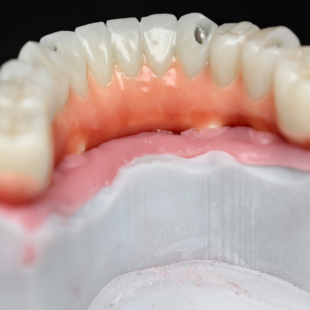 Zirconia-Enamel Hybrid Malo Bridge