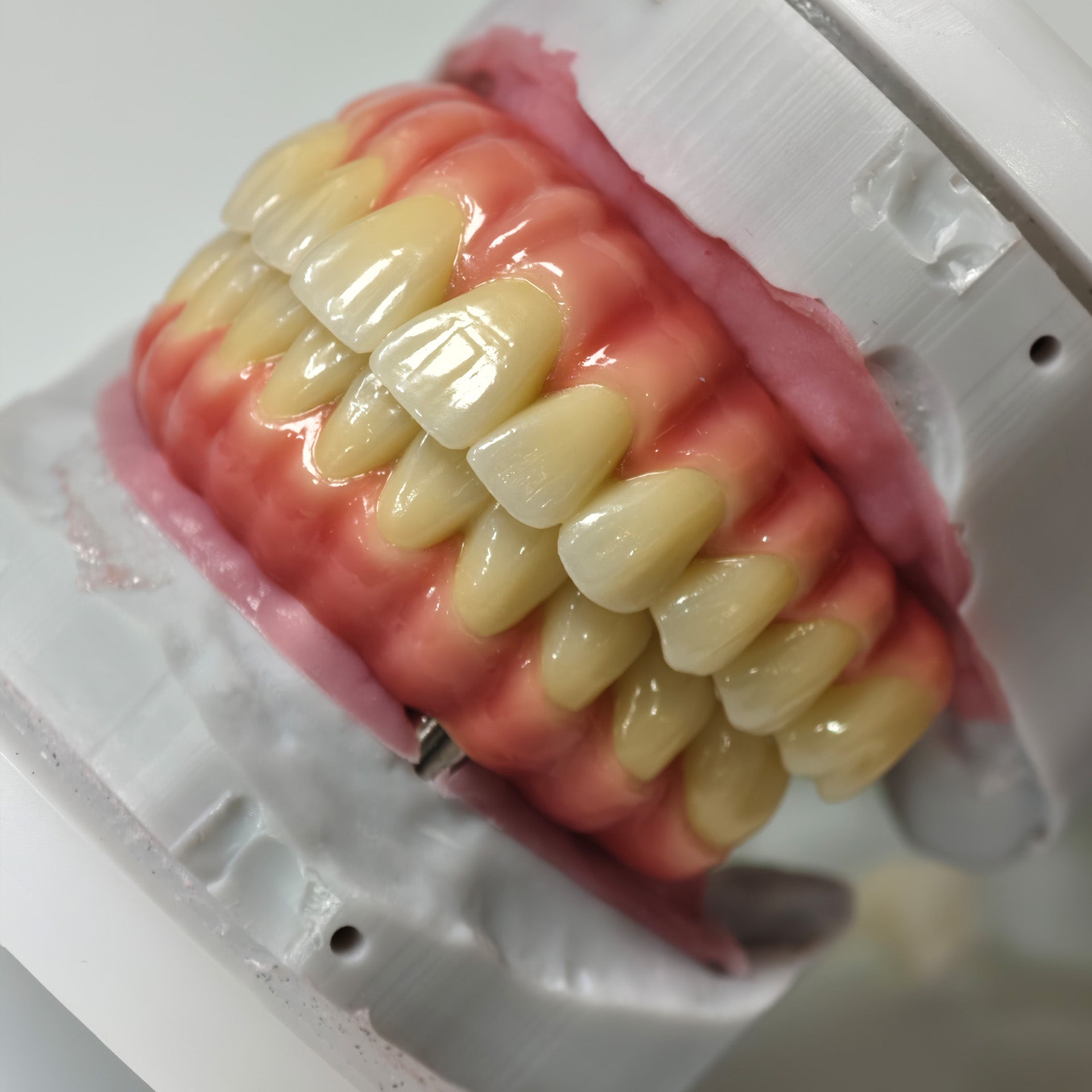 Zirconia-Enamel Hybrid Malo Bridge