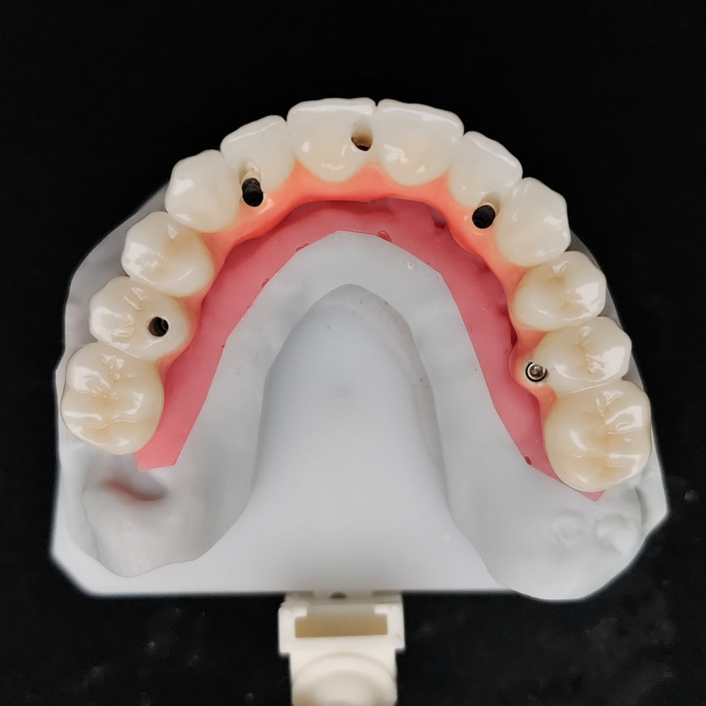 Zirconia-Enamel Hybrid Malo Bridge