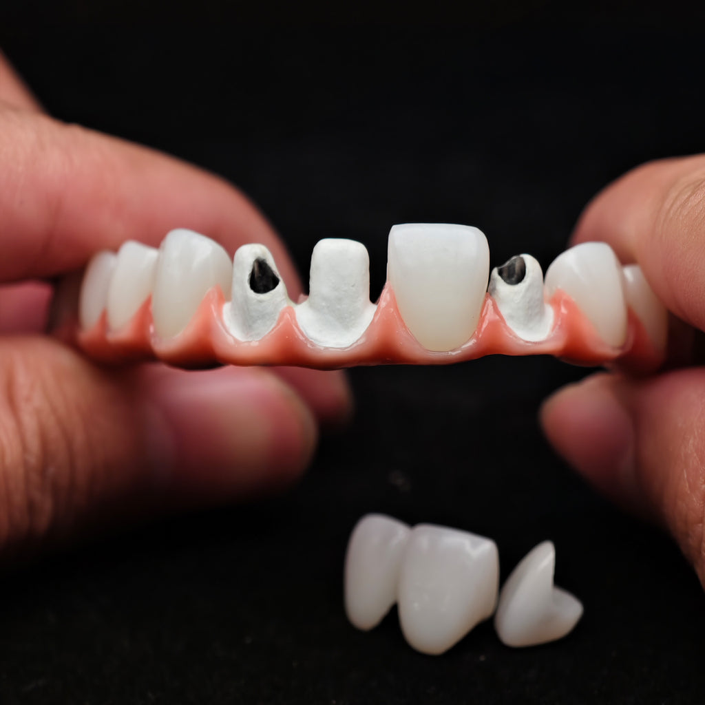Zirconia-Enamel Hybrid Malo Bridge