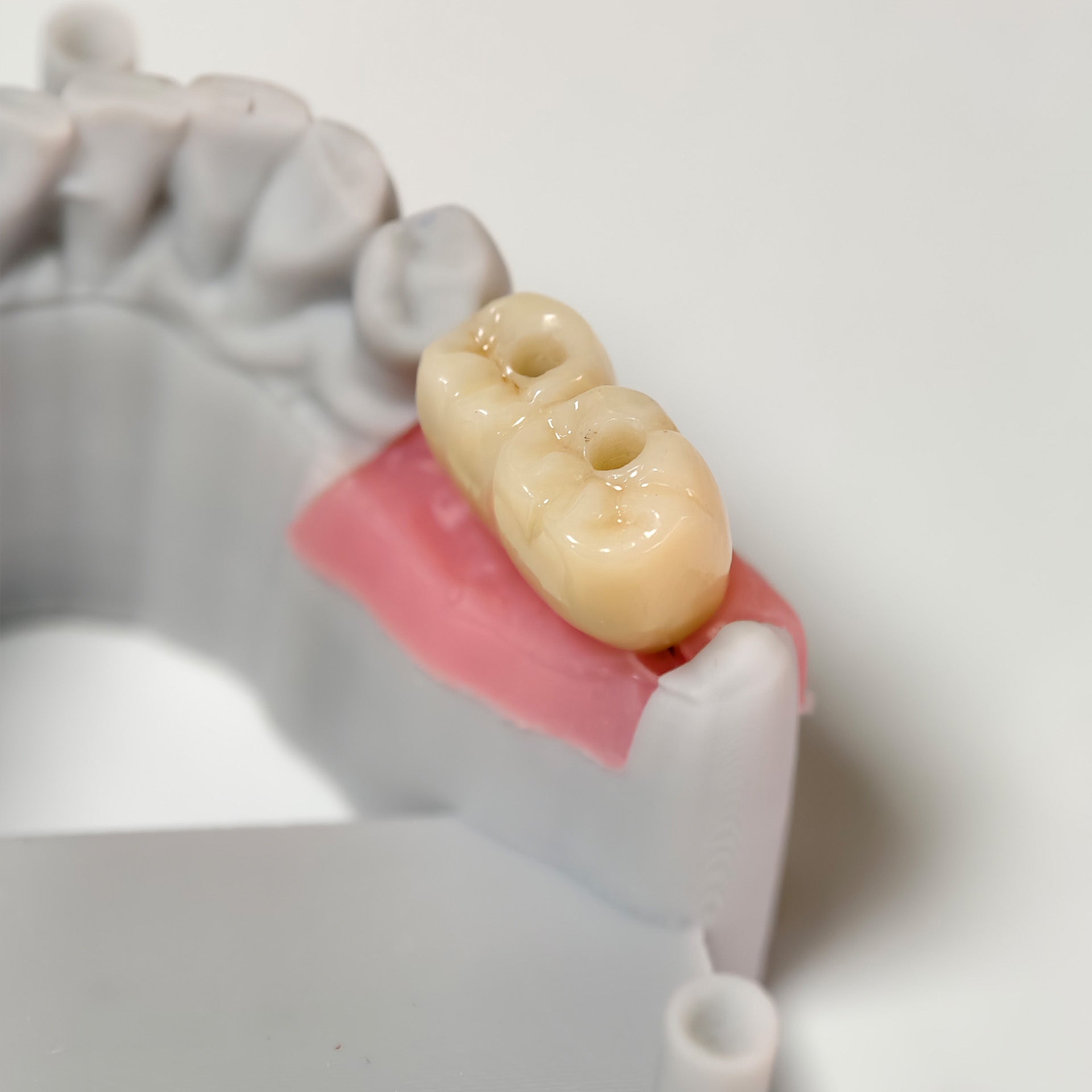 Zirconia Bridge With Screw Retained