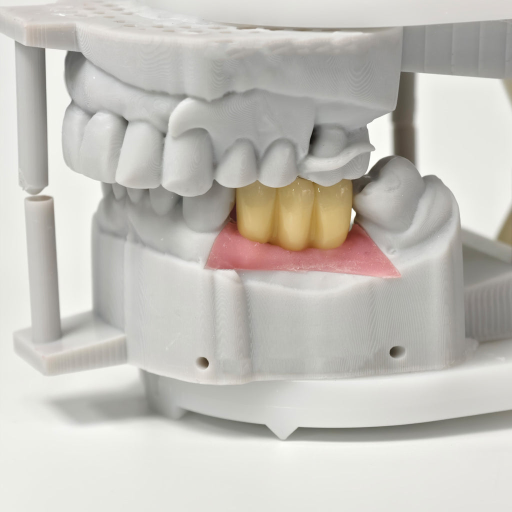 Zirconia Bridges With Screw Retained