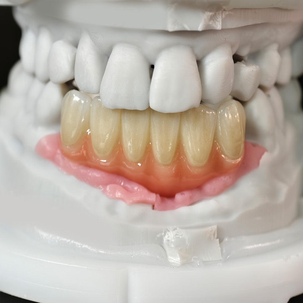 Zirconia Bridge With Ti-Base Screw Retained