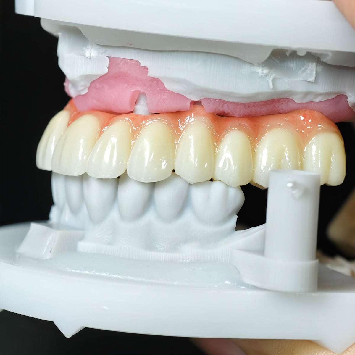 Zirconia Bridge With Cement Retained