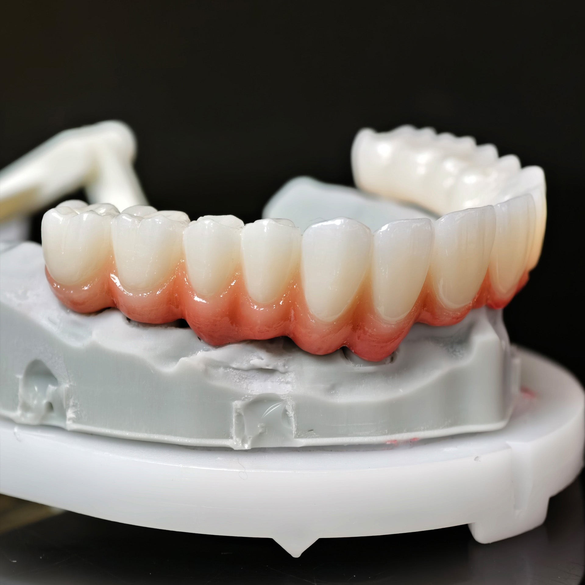 Zirconia Bridge With Cement Retained And Titanium Bar