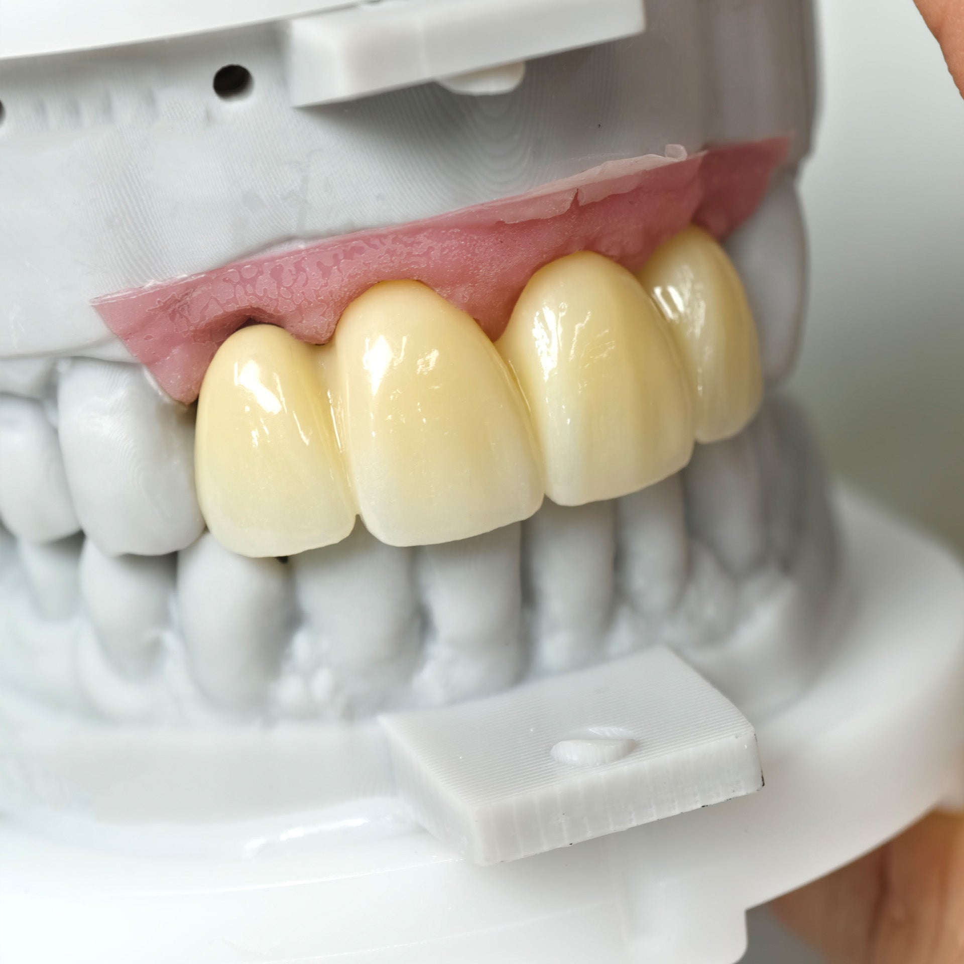 Zirconia Bridge With Screw Retained