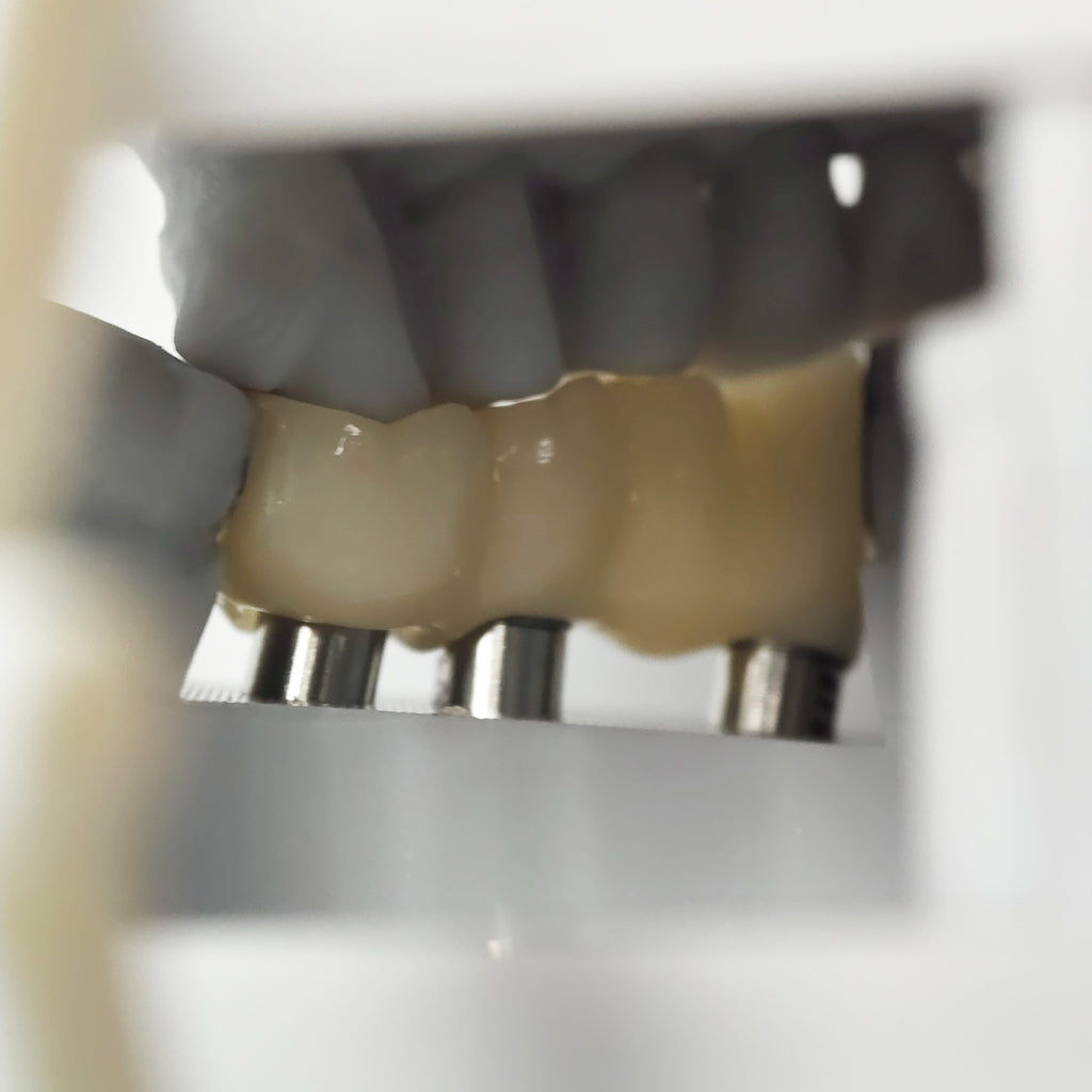 Zirconia Bridge With Ti-Base Screw Retained