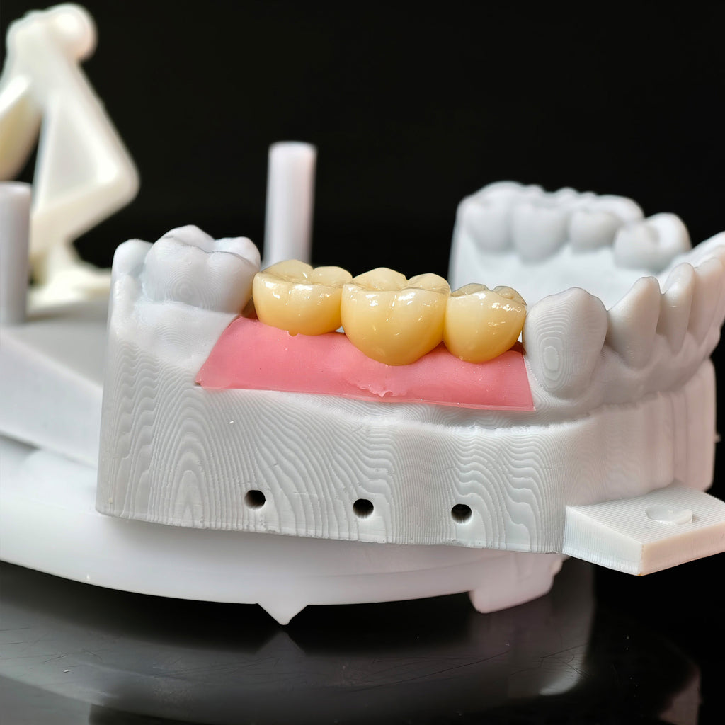 Zirconia Crowns With Gold-Plated Abutment And Implant Seating Guide