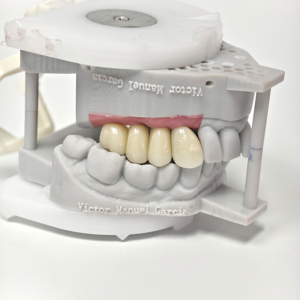 Zirconia Crowns With Screw Retained