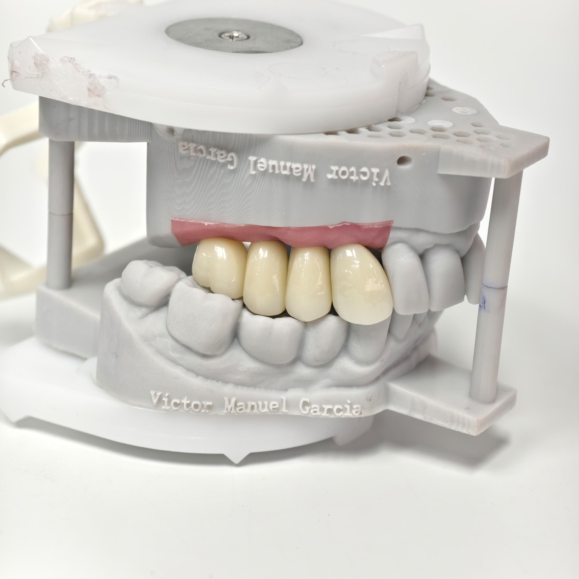 Zirconia Crowns With Screw Retained