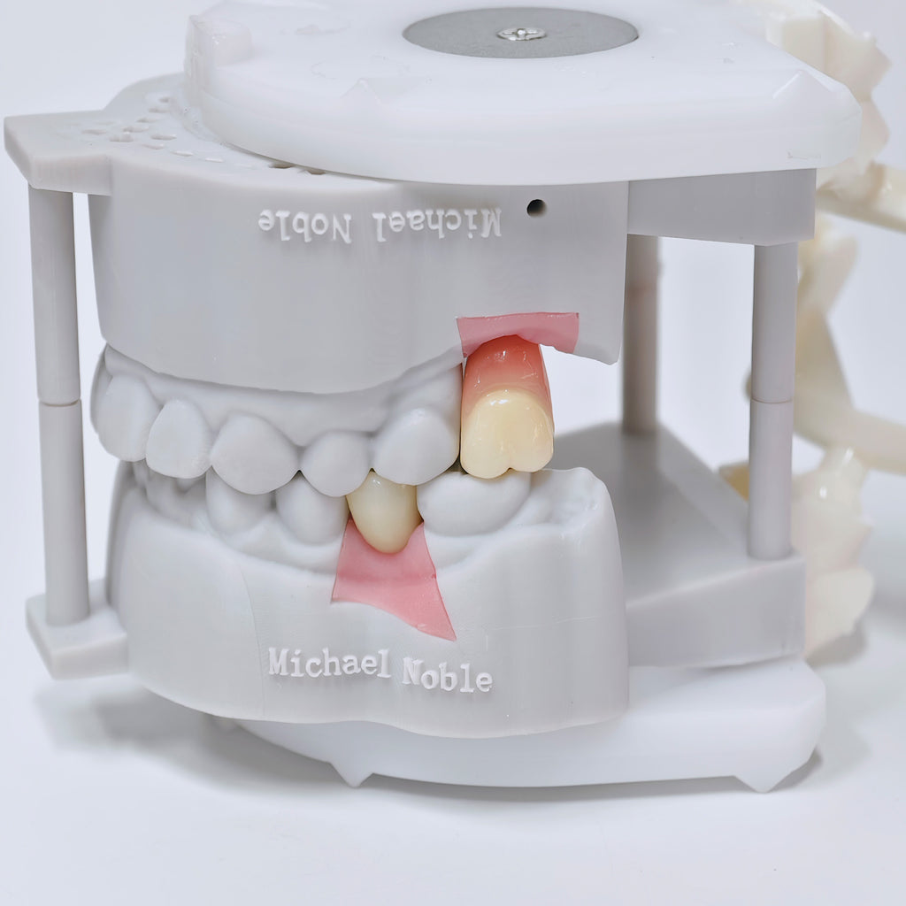 Zirconia Crowns With Screw Retained