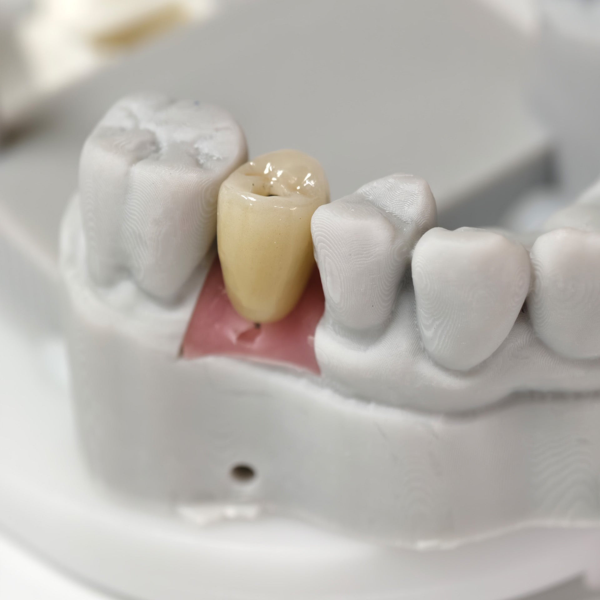 Zirconia Crowns With Screw Retained