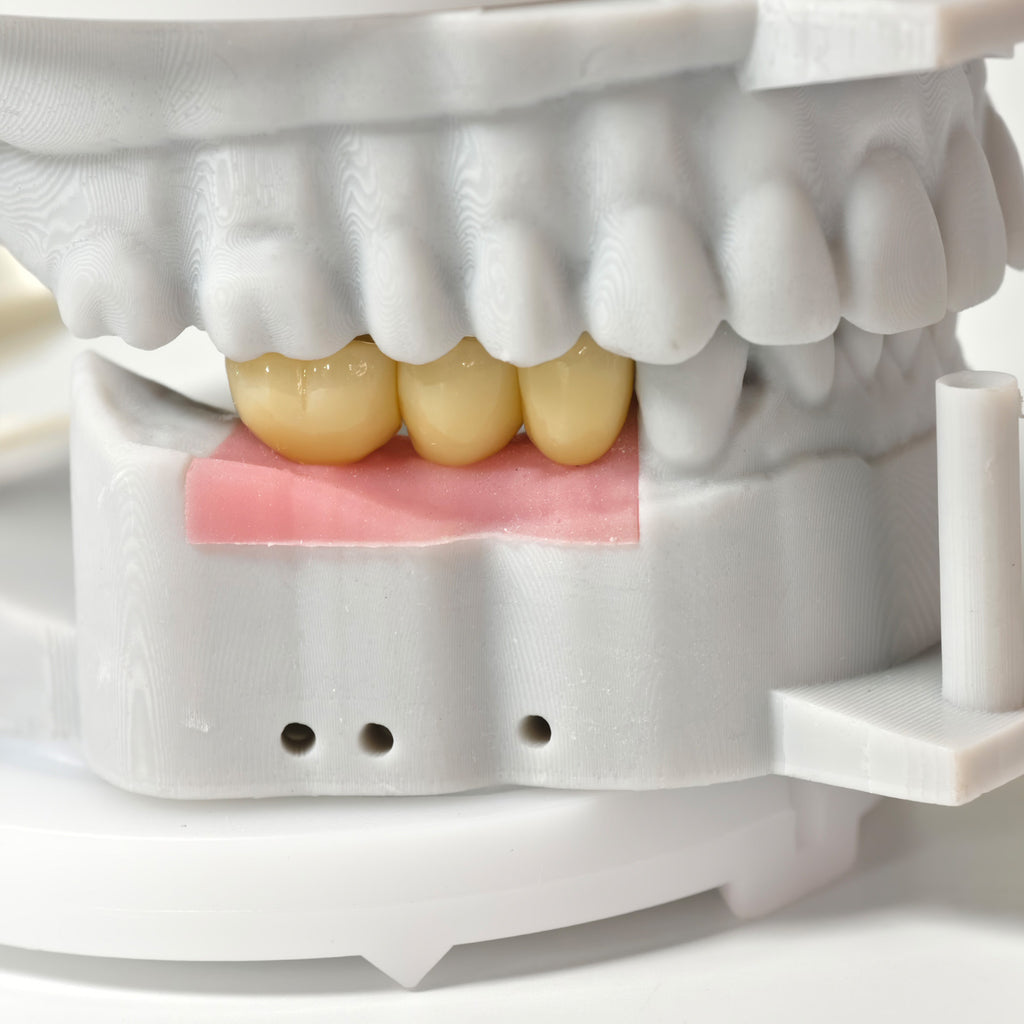 Zirconia Crowns With Screw Retained