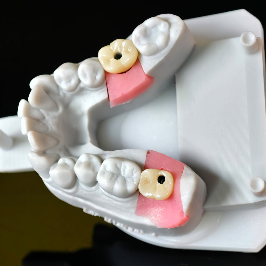 Zirconia Crowns With Screw Retained