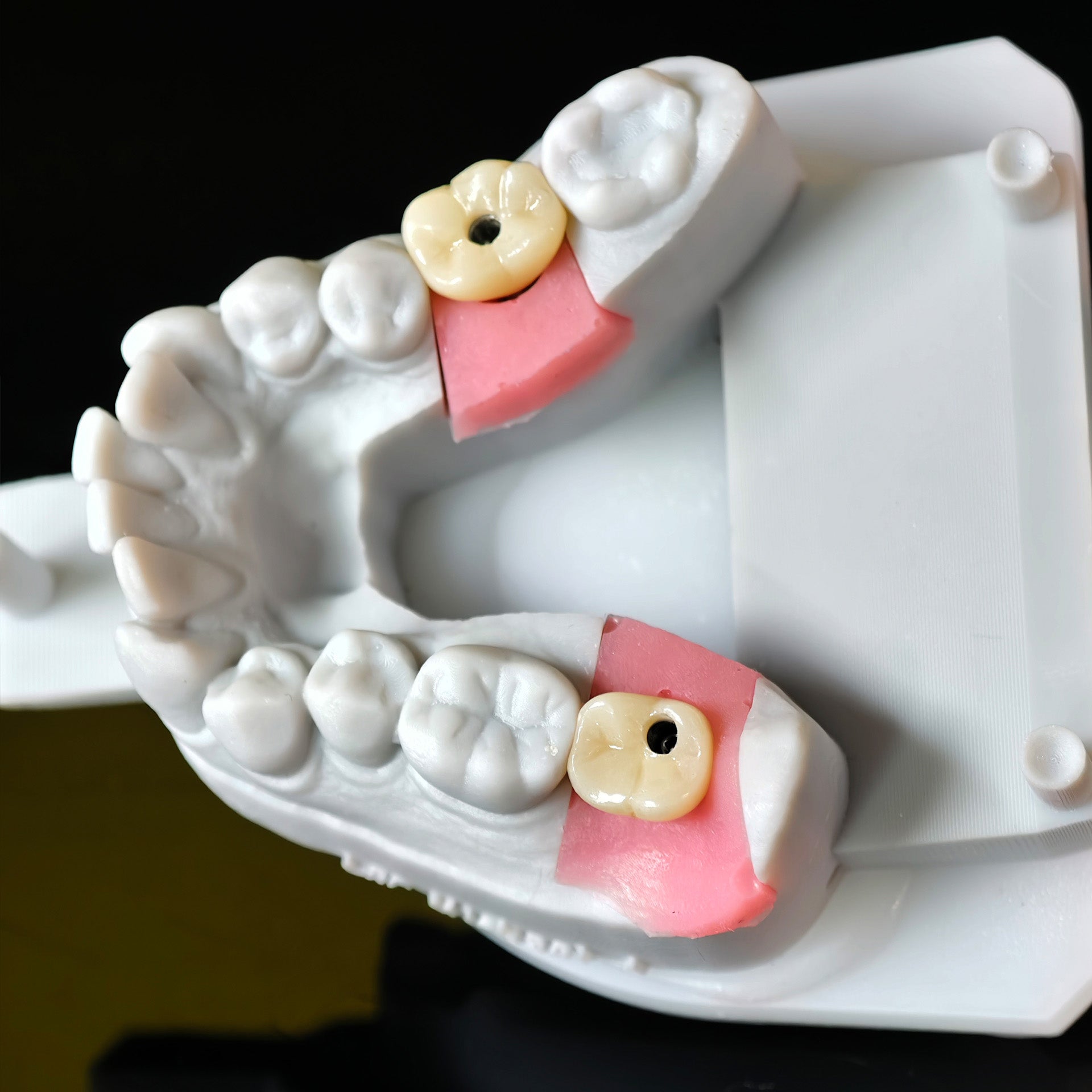 Zirconia Crowns With Screw Retained