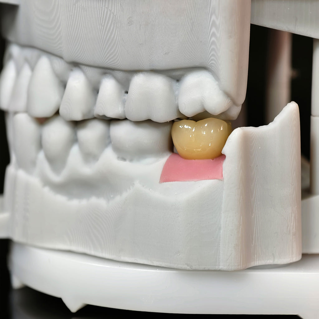 Zirconia Crowns With Screw Retained