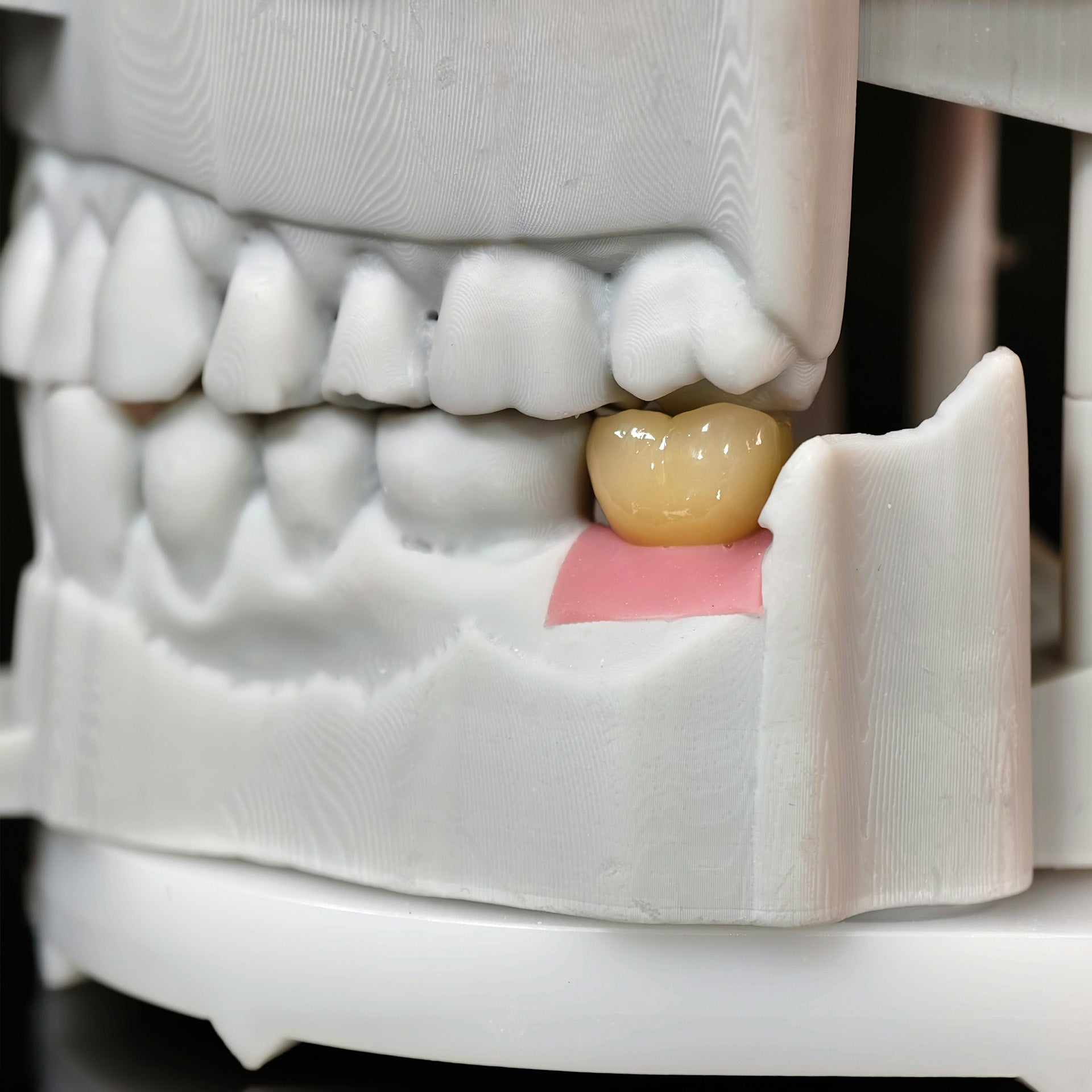 Zirconia Crowns With Screw Retained