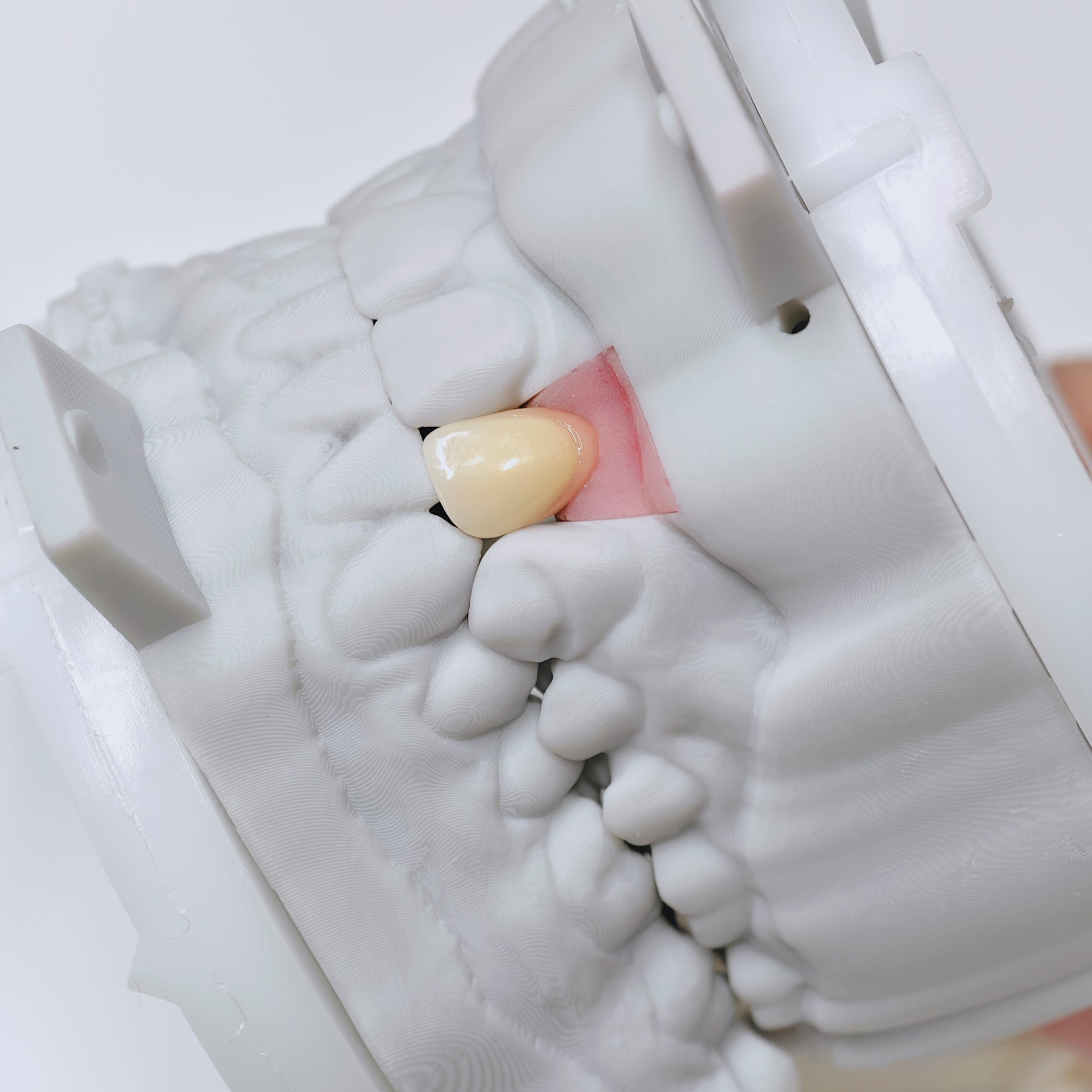 Zirconia Crown With Screw Retained