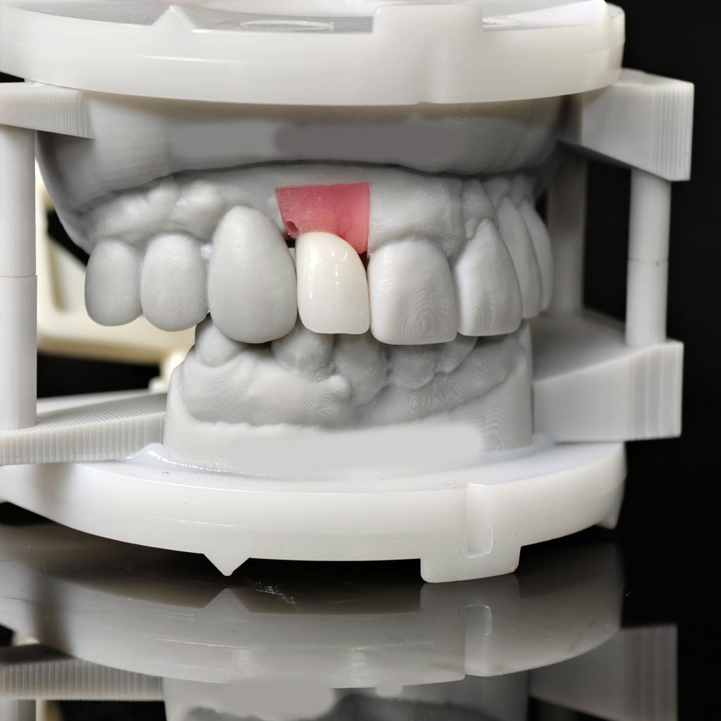 Zirconia Crown With Screw Retained