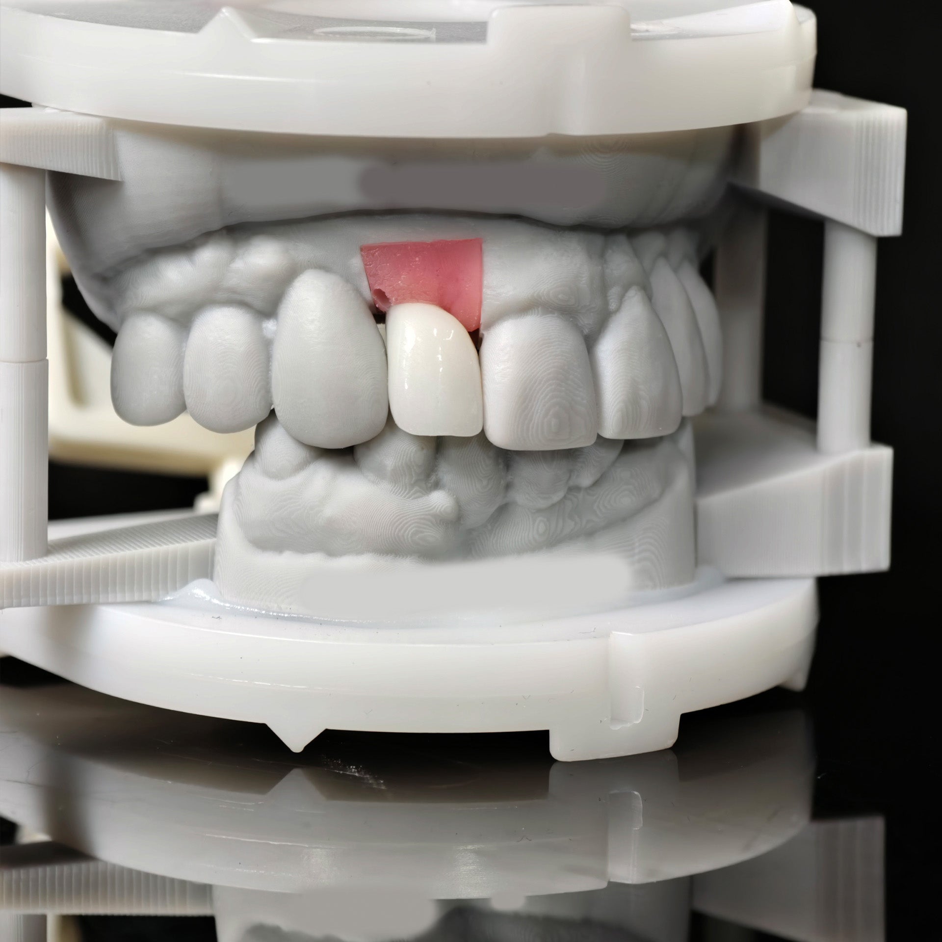 Zirconia Crown With Screw Retained