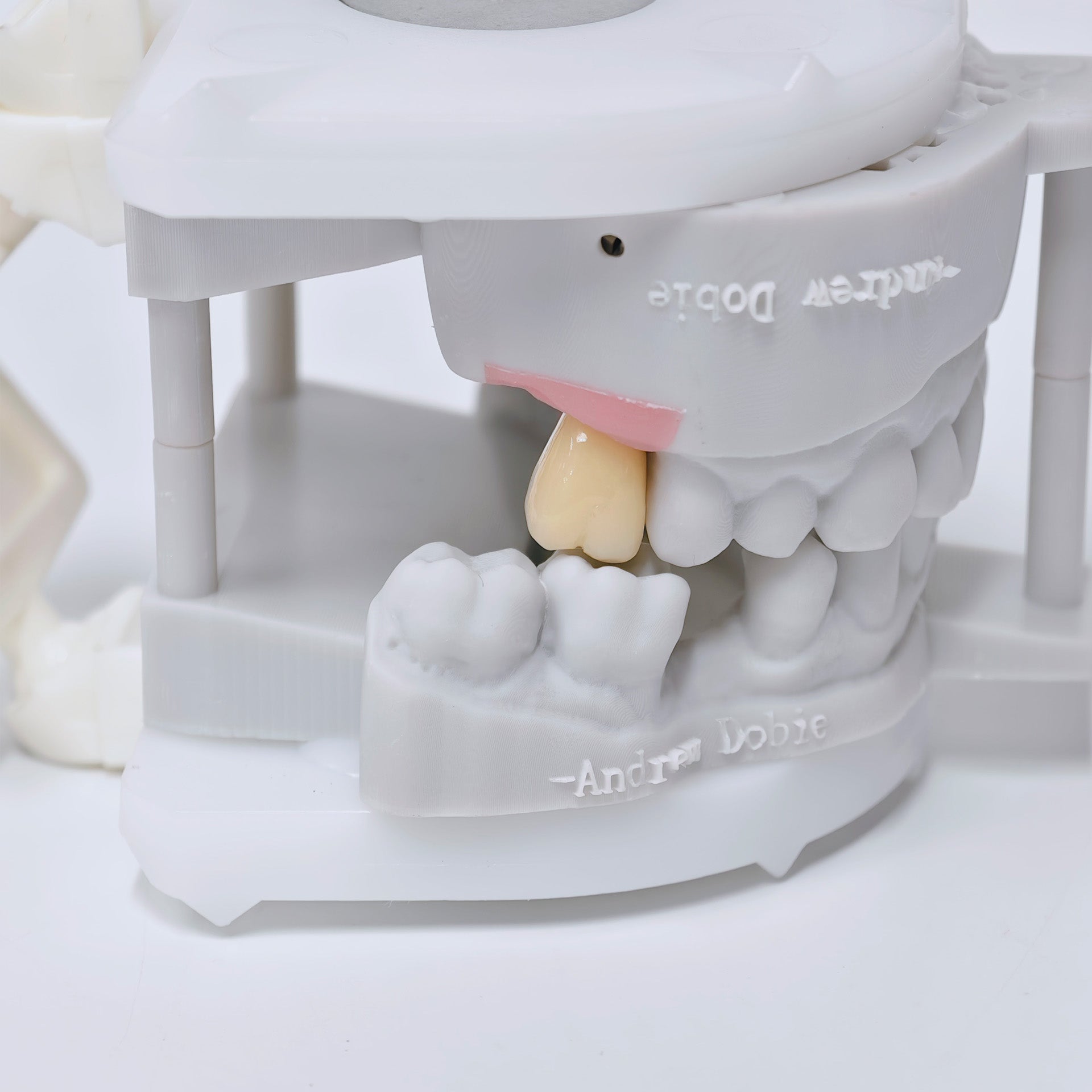 Zirconia Crown With Screw Retained