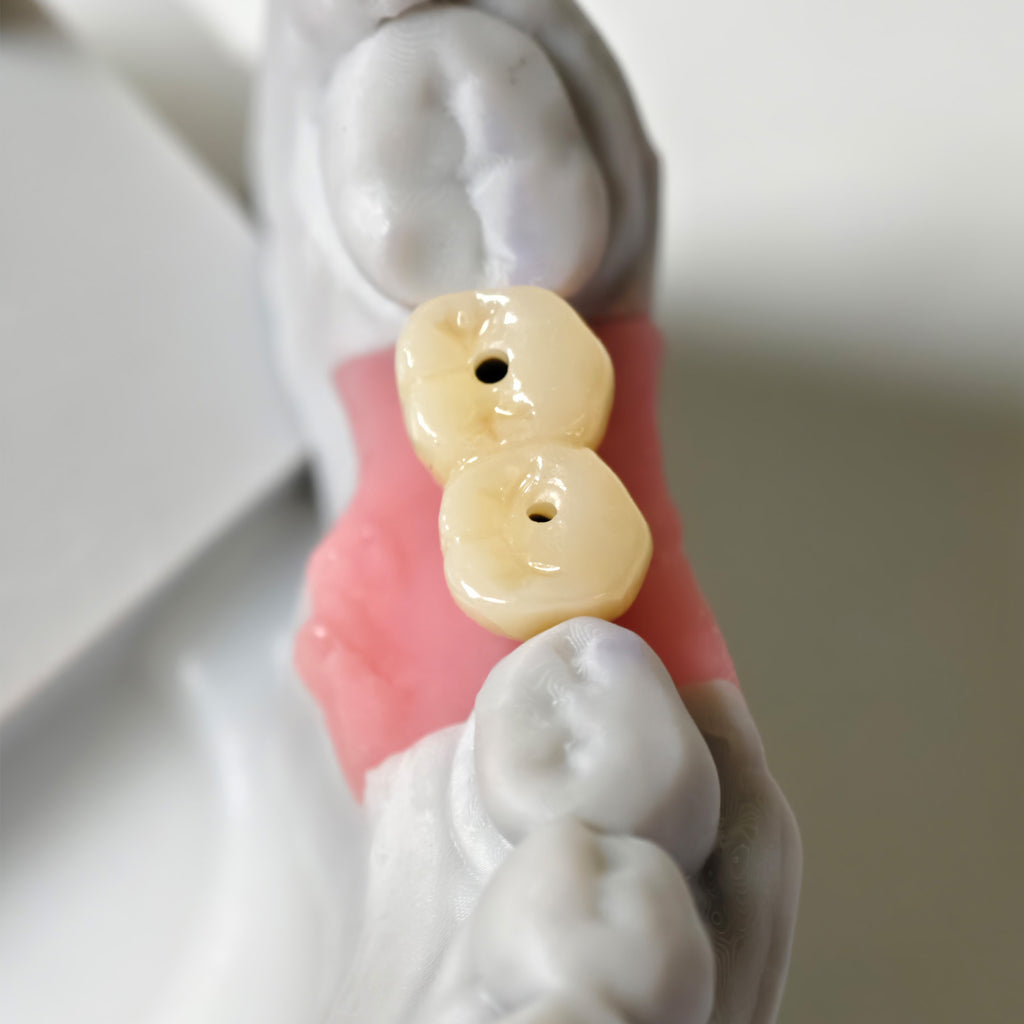 Zirconia Implant Bridge Screwmentable Dental Crown