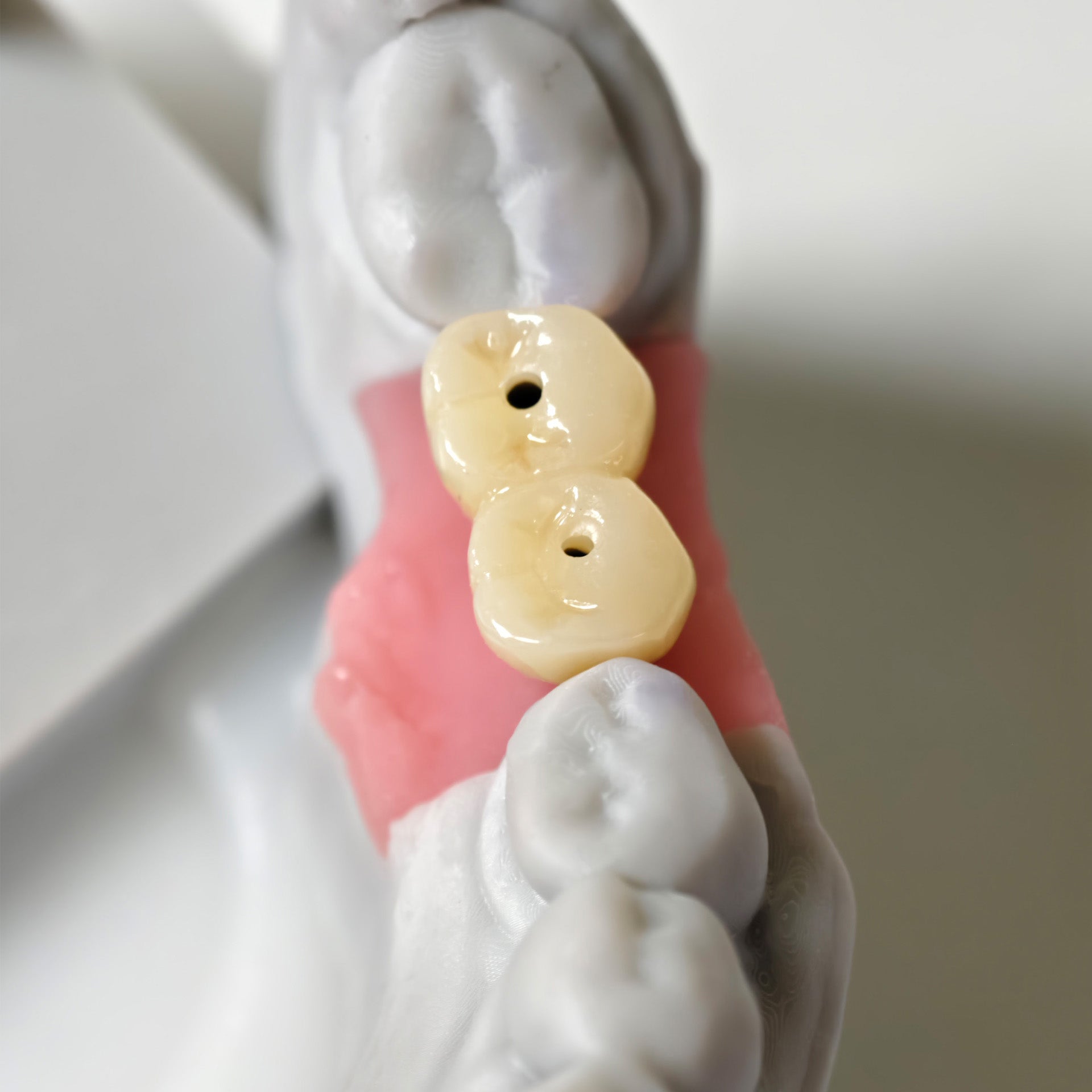 Zirconia Implant Bridge Screwmentable Dental Crown