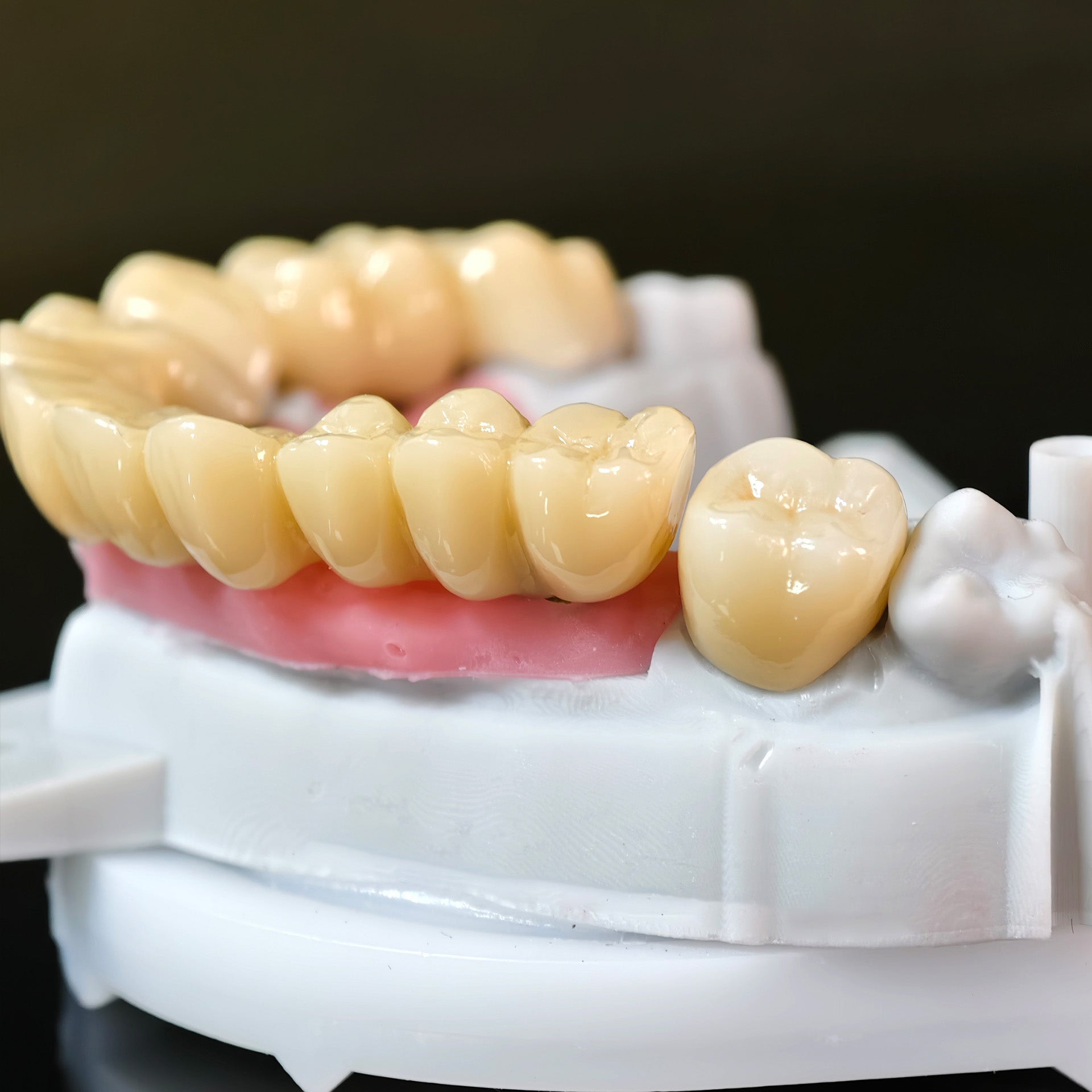 Zirconia Implant Bridge Screwmentable Dental Crown