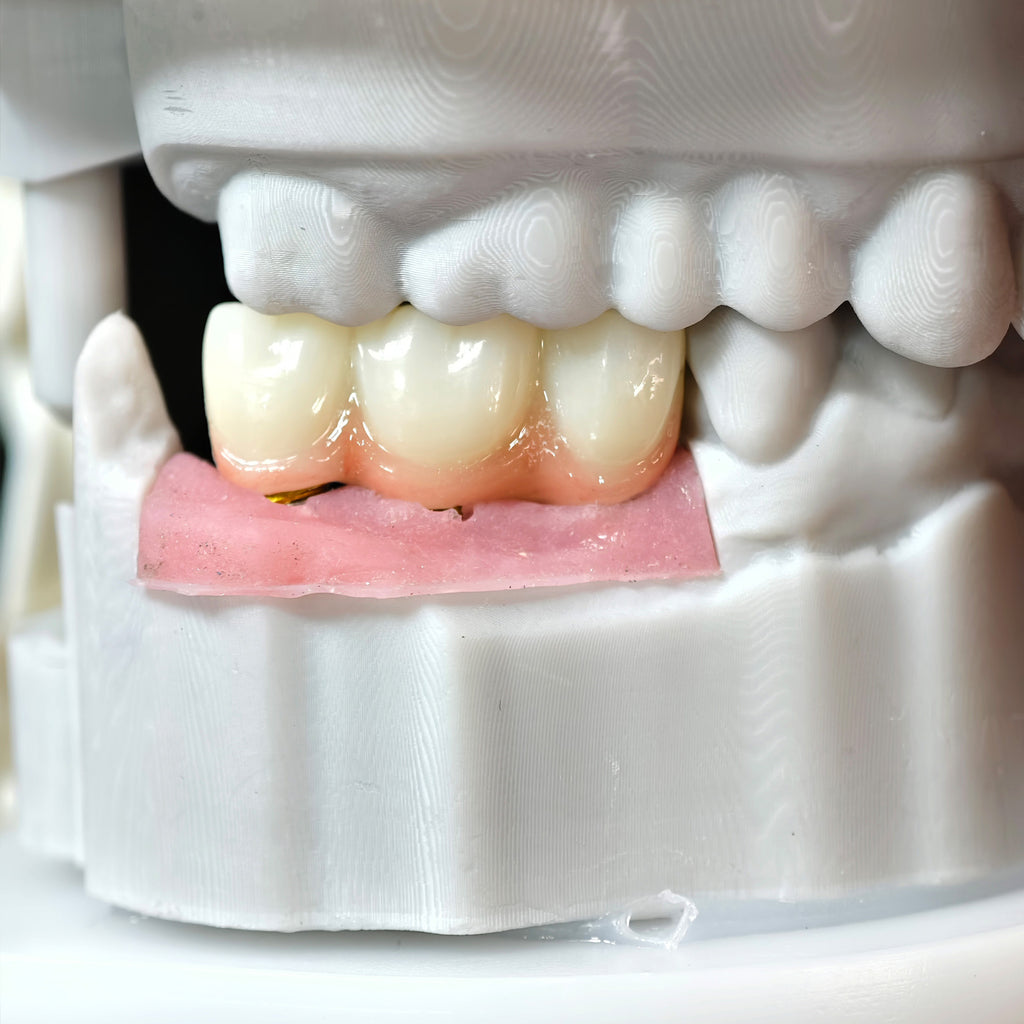 Zirconia Implant Bridge Screwmentable Dental Crown