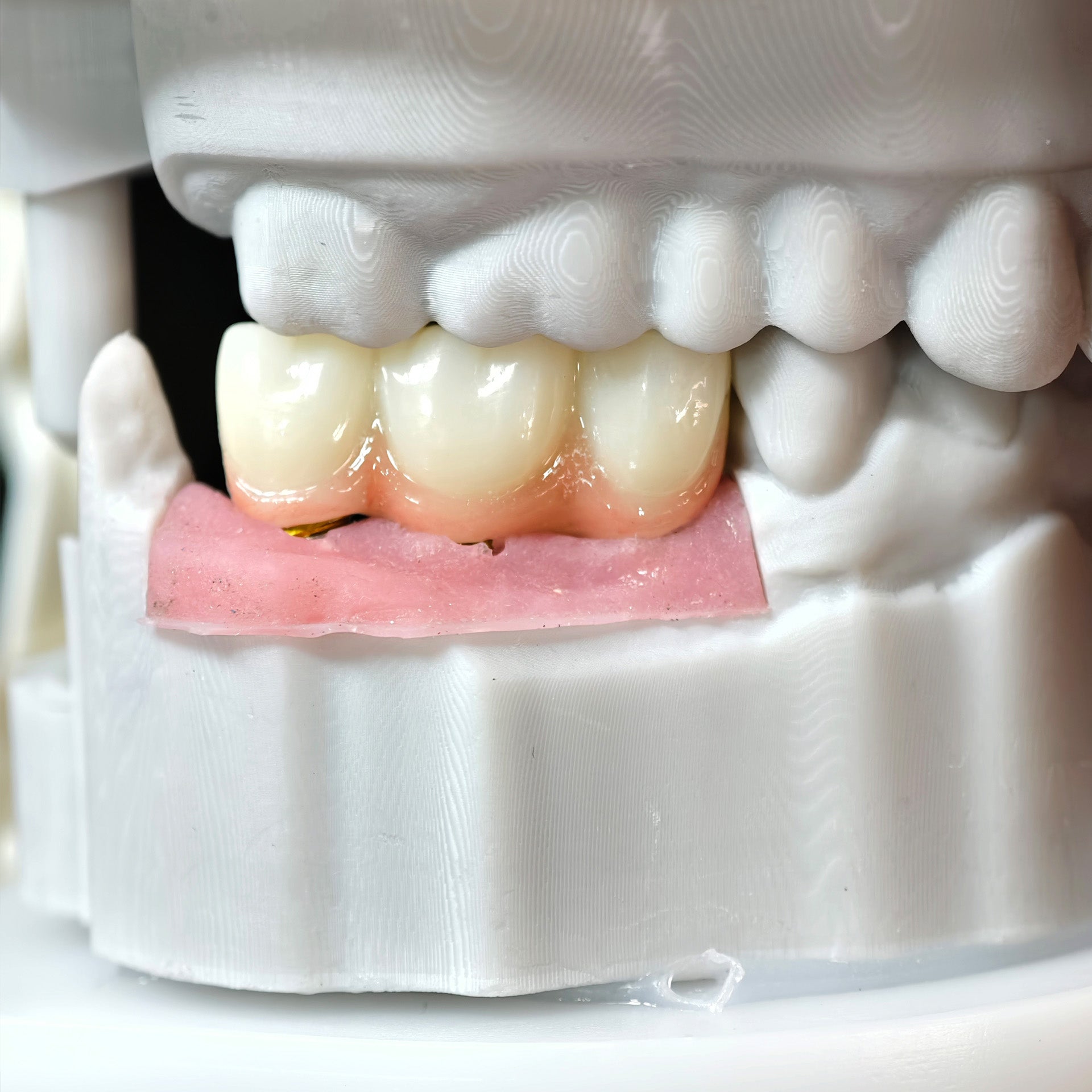 Zirconia Implant Bridge Screwmentable Dental Crown