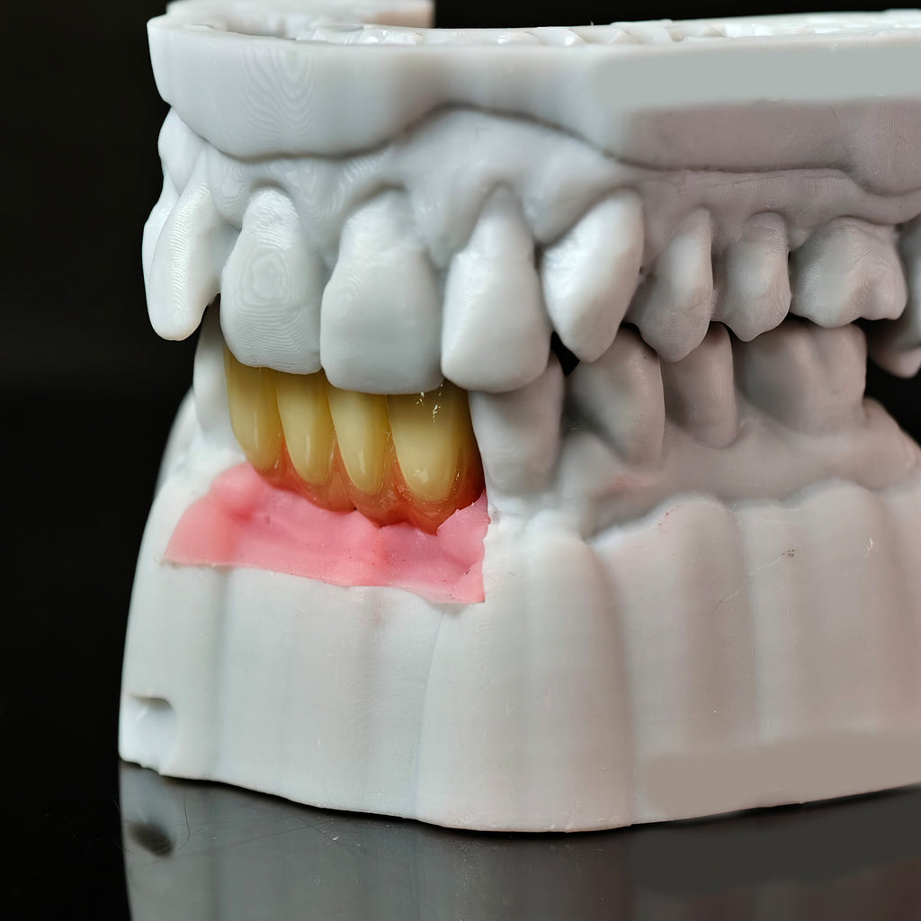 Zirconia Implant Bridge With Gold Plating
