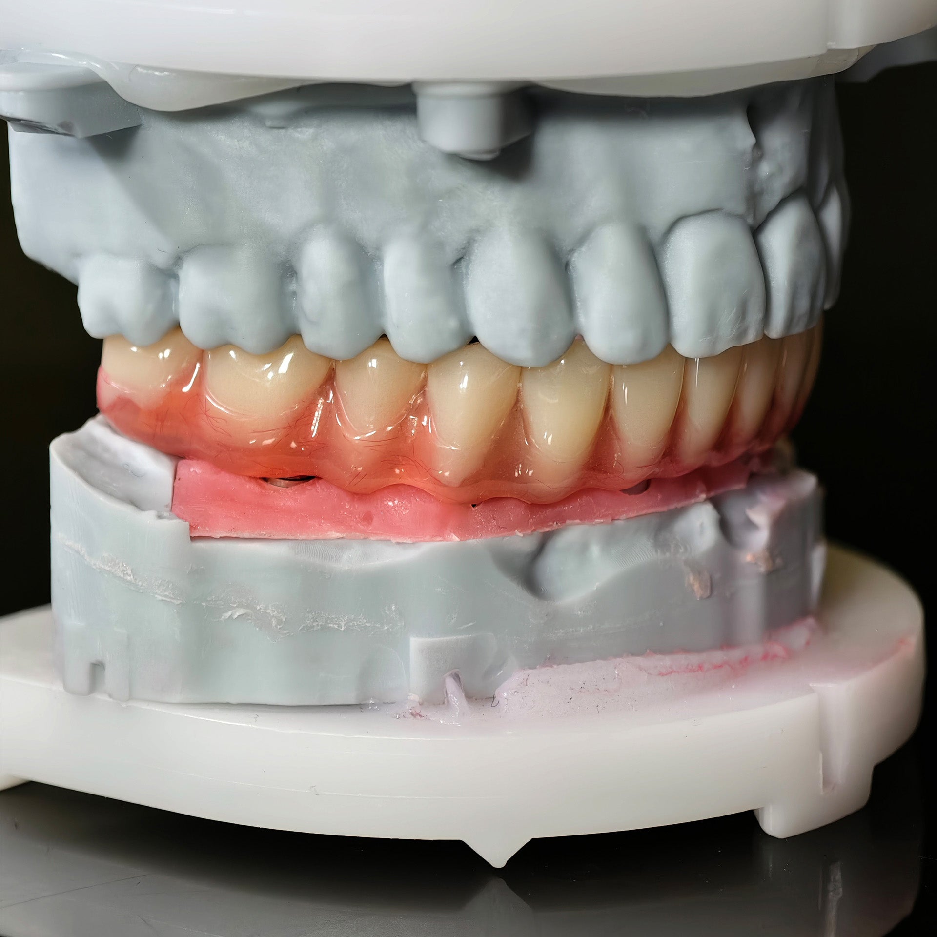 Acrylic Denture With Screw Retained