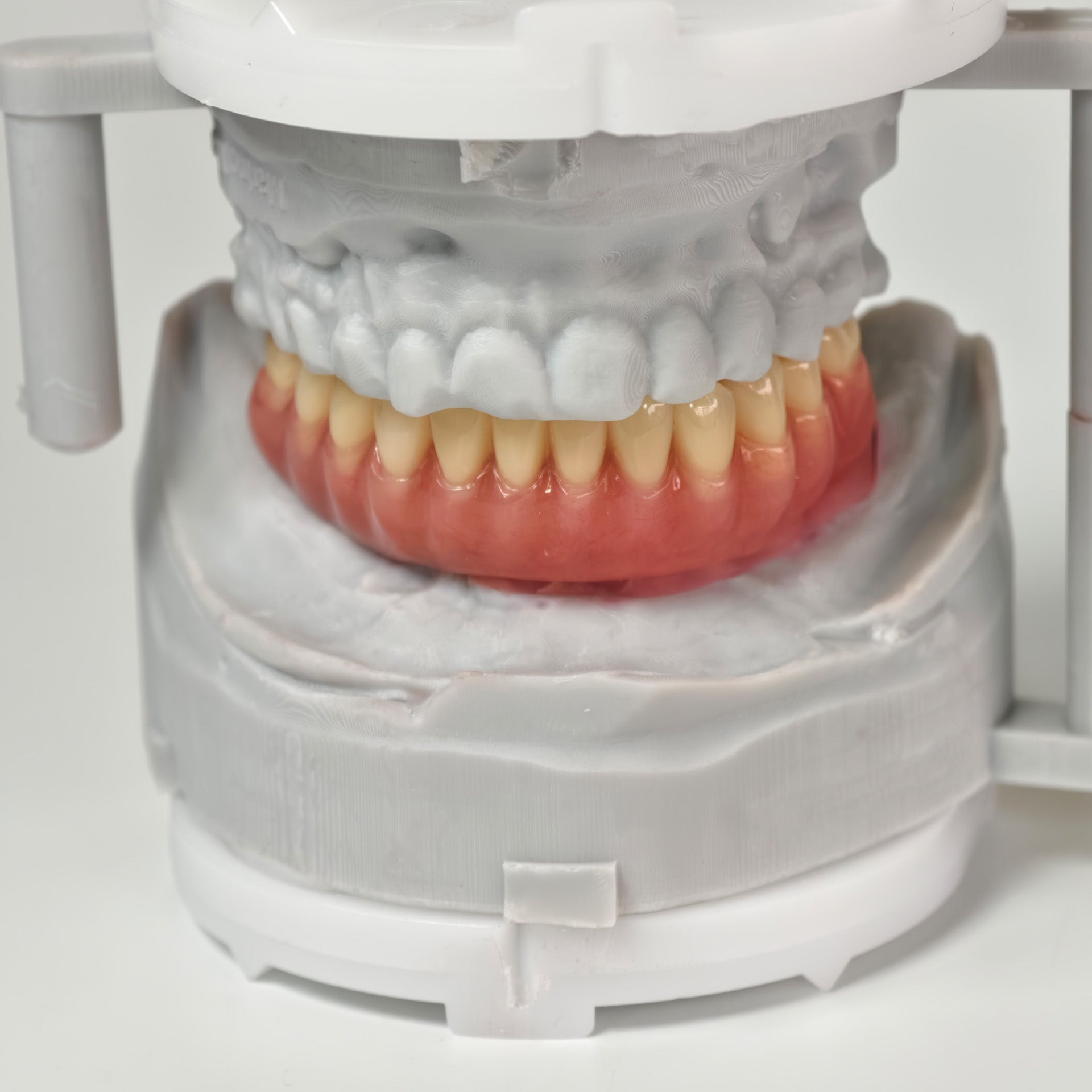 Acrylic Denture With Ti-Bar And Screw Retained