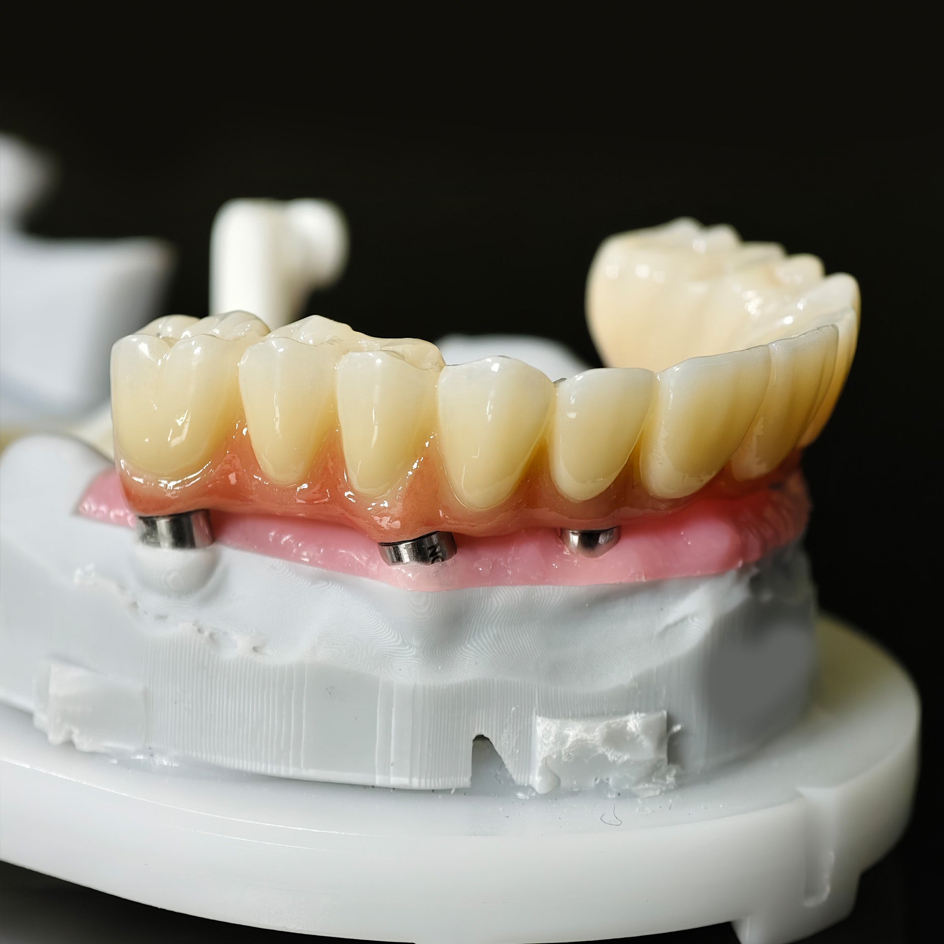 All On 5 Zirconia Bridge With Ti-Base Screw Retained Trying For Full Arch Restoration
