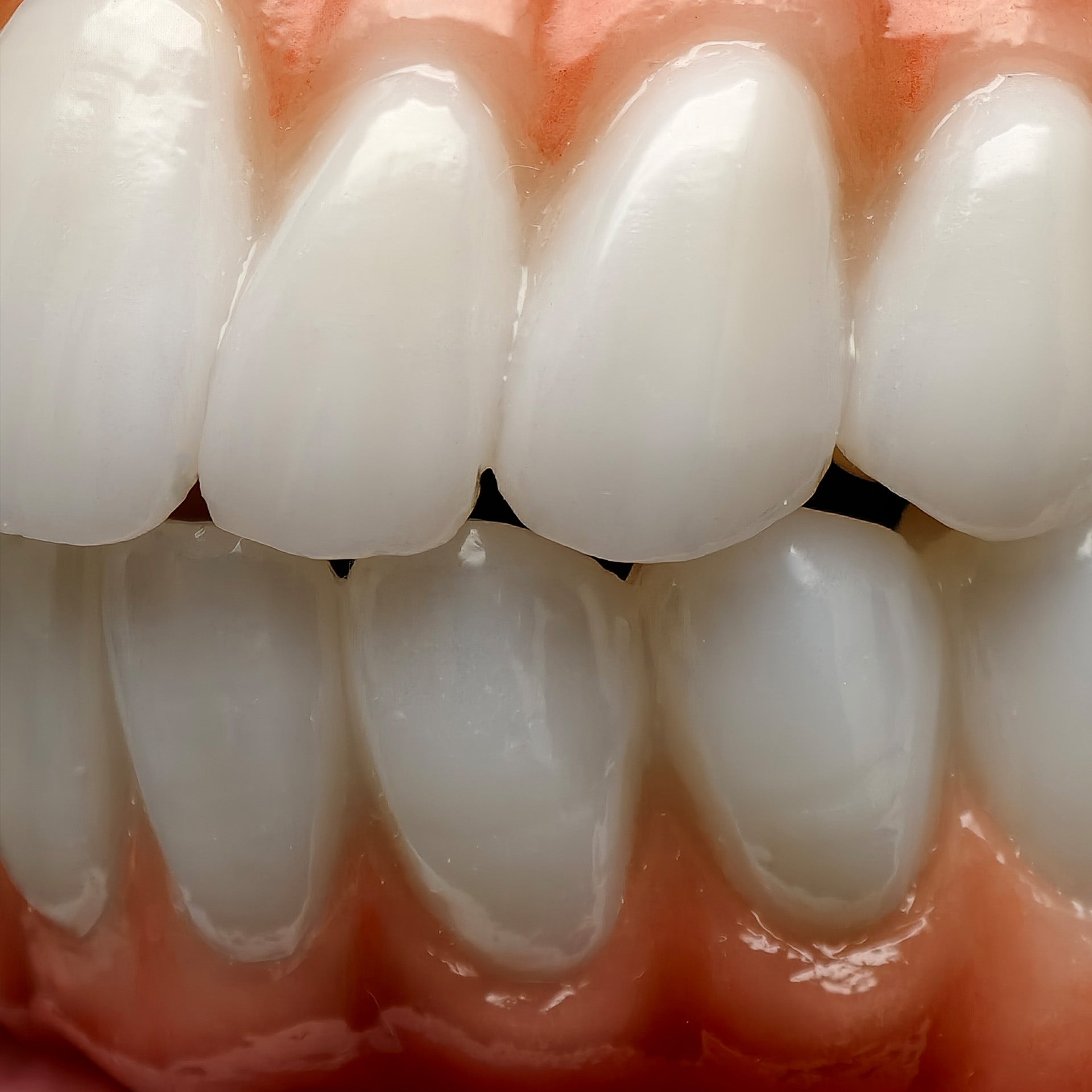 All On 5 Zirconia Bridge With Ti-Base Screw Retained Trying For Full Arch Restoration
