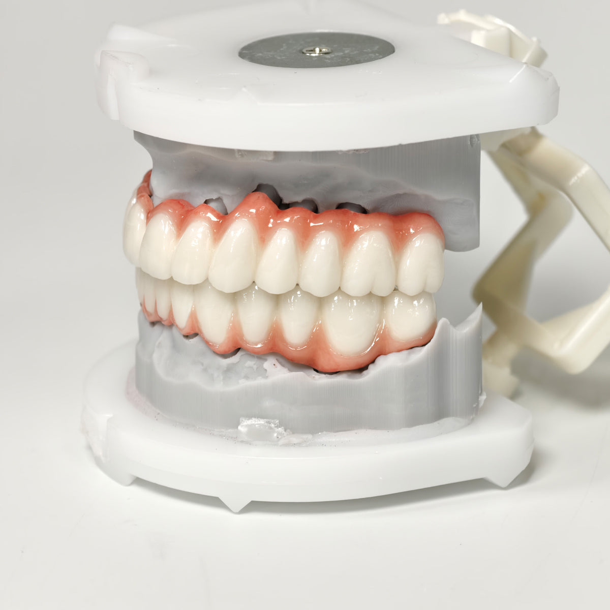 Full-Arch PFM Bridge With Screw Retained