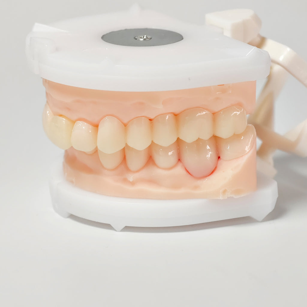 Full-Mouth Segmented PMMA Bridge With Cement Retained