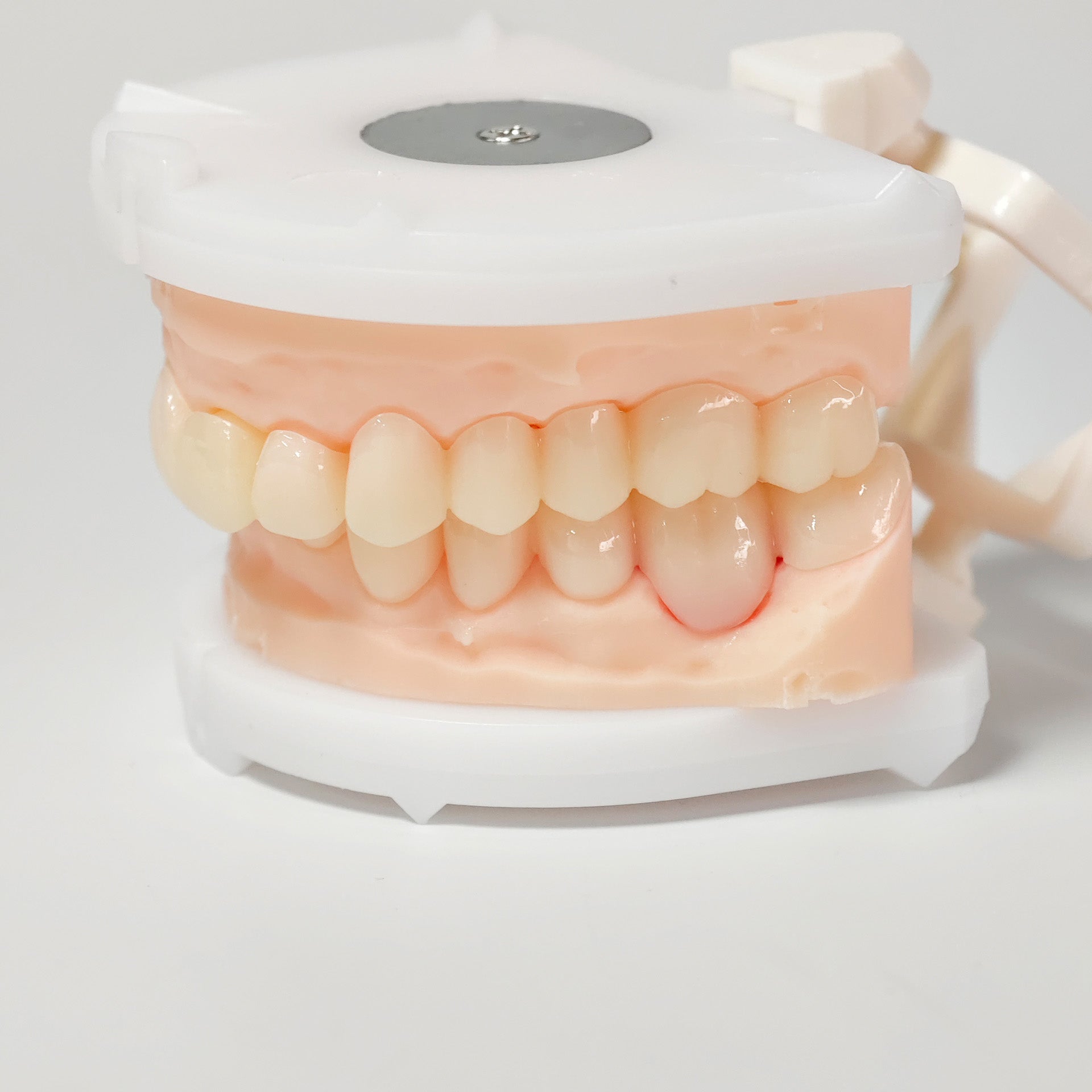Full-Mouth Segmented PMMA Bridge With Cement Retained