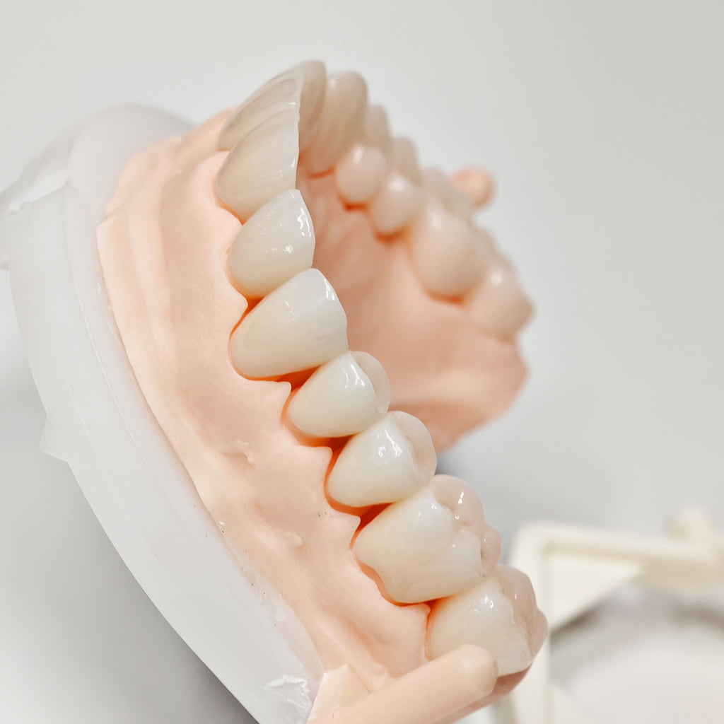 Full-Zriconia Crowns With Cement-Retained