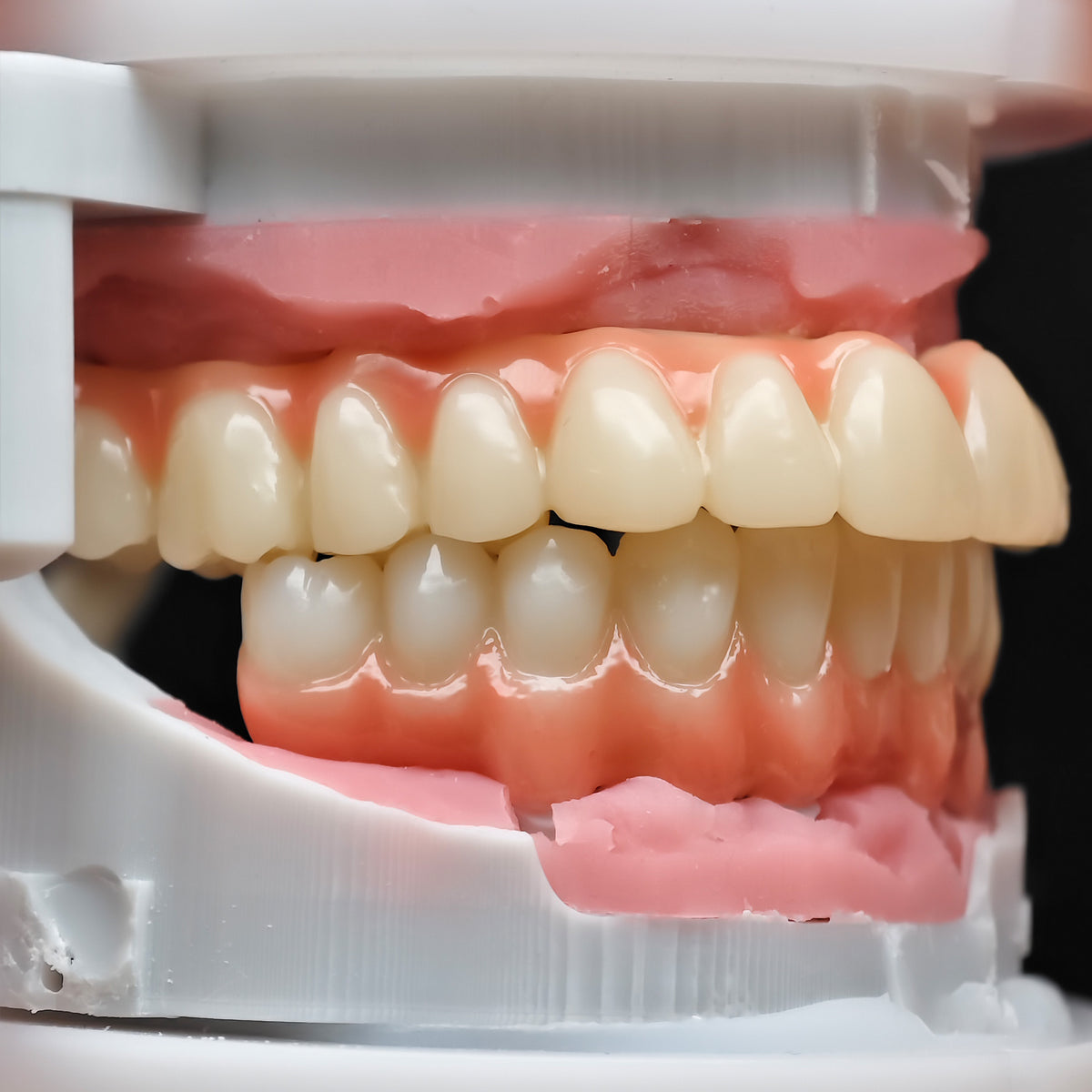 Pmma Bridge And Zirconia Bridge With Cemented