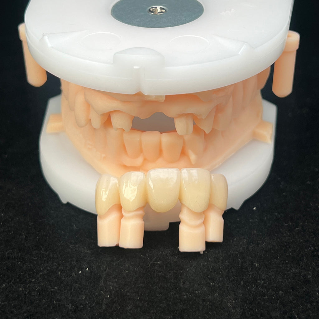 Multilayer Zirconia Bridges Aesthetic And Natural Restoration