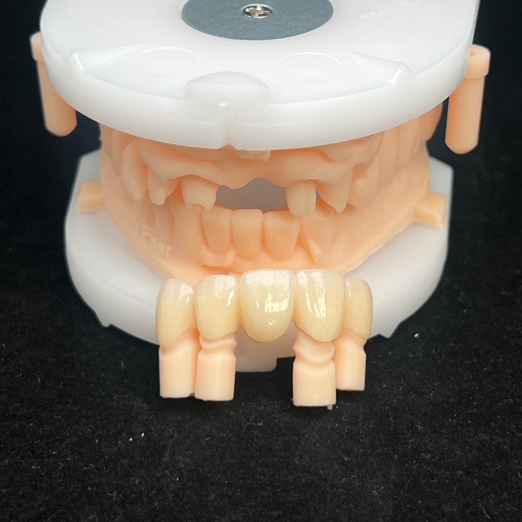 Multilayer Zirconia Bridges Aesthetic And Natural Restoration