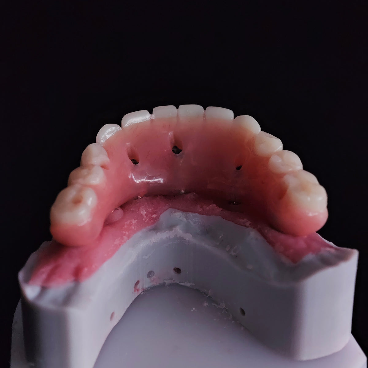 An Acrylic Denture With A Titanium Bar (Ti-Bar) Cost-Effective Full Arch Restoration Screw Retained