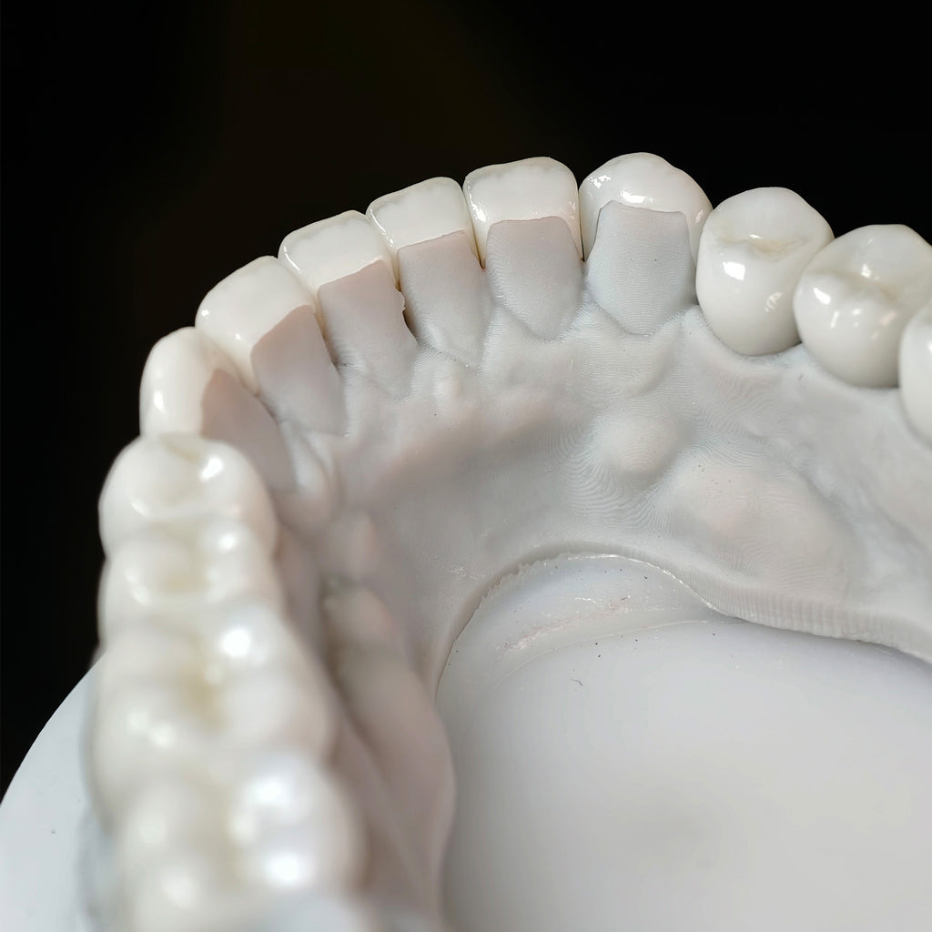 Ceramic Veneers And Crown With Cement Retained